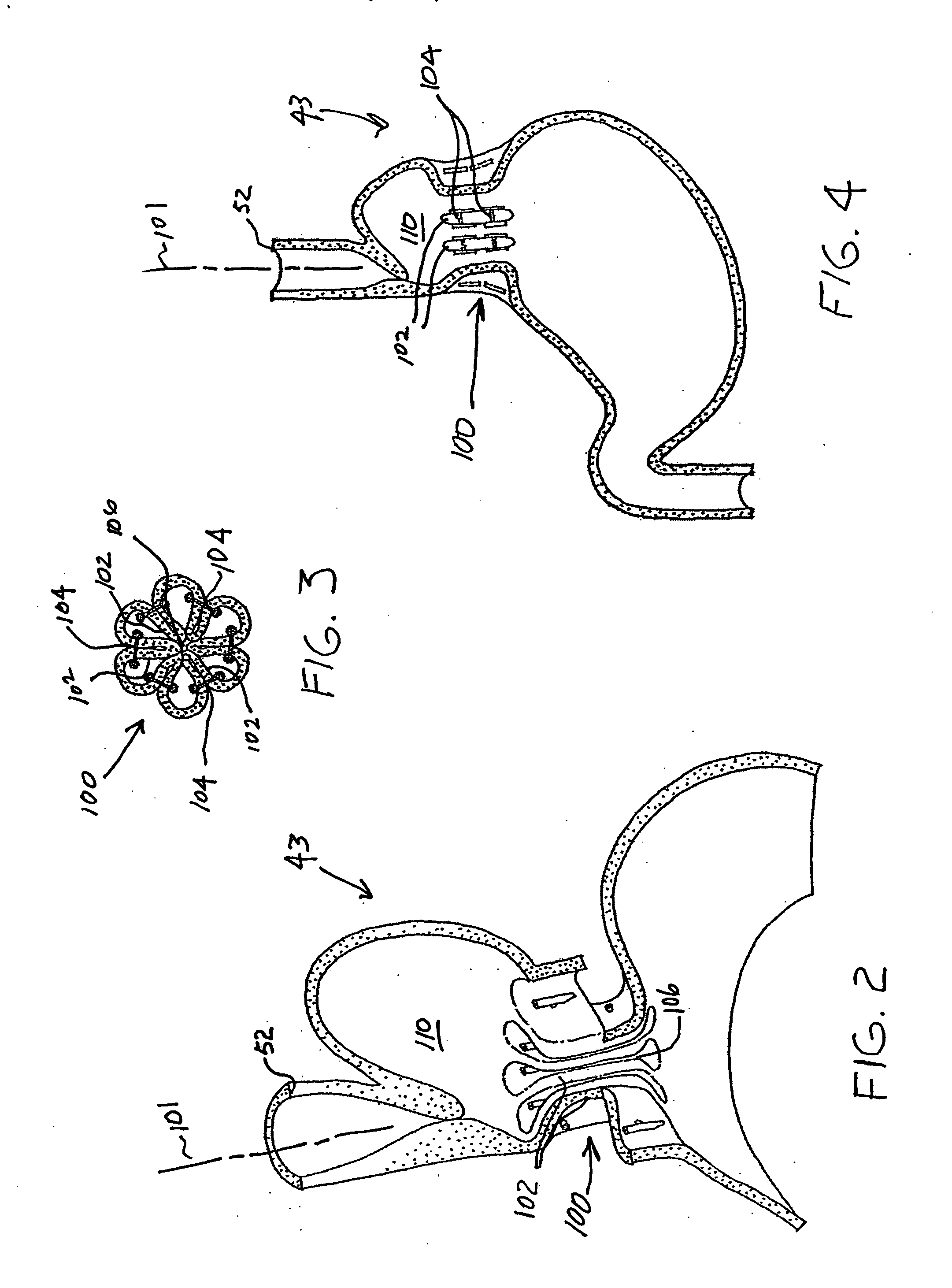 Transesophageal gastric reduction method and device for practicing same