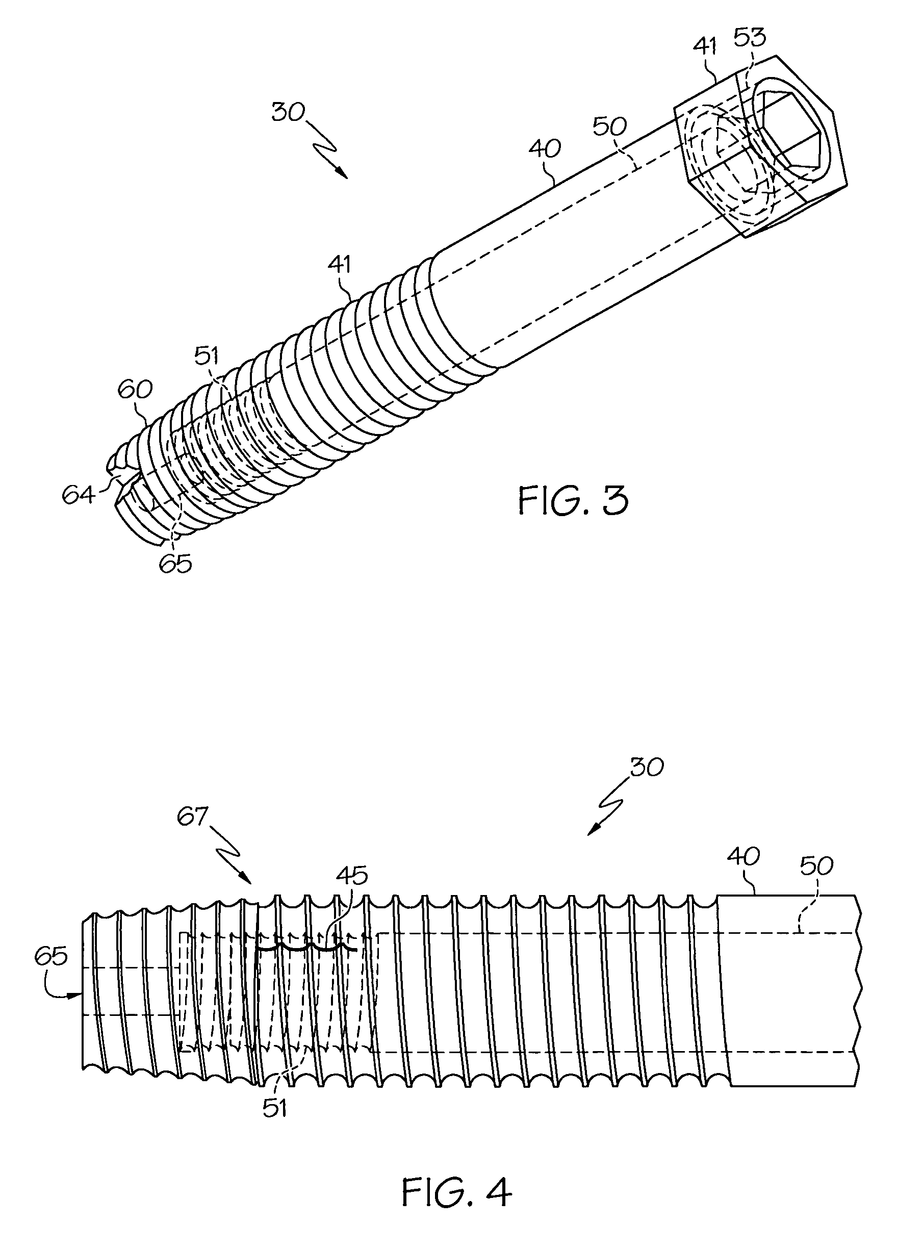 Spinal facet fixation device