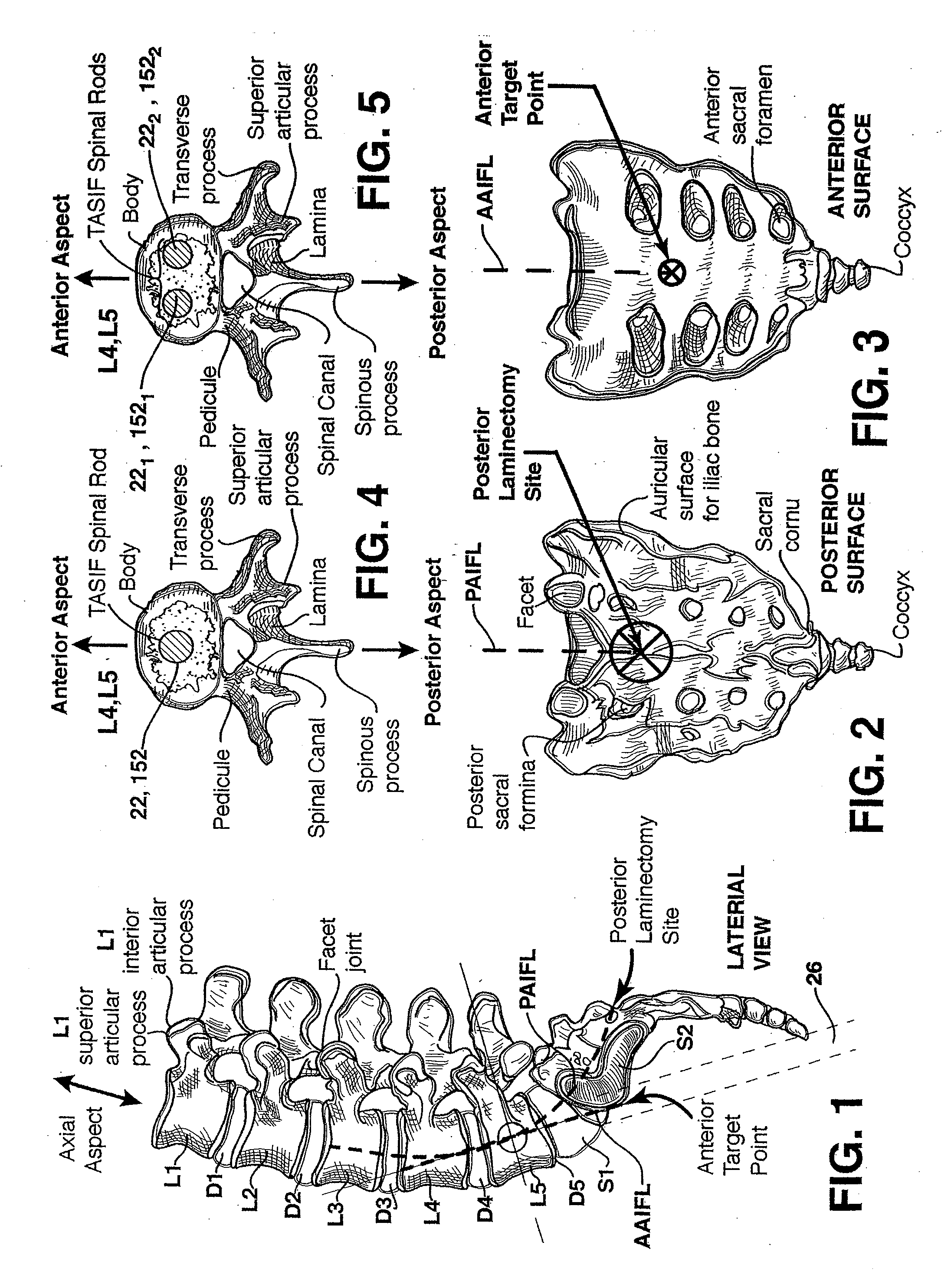 Method and apparatus for providing posterior or anterior trans-sacral access to spinal vertebrae