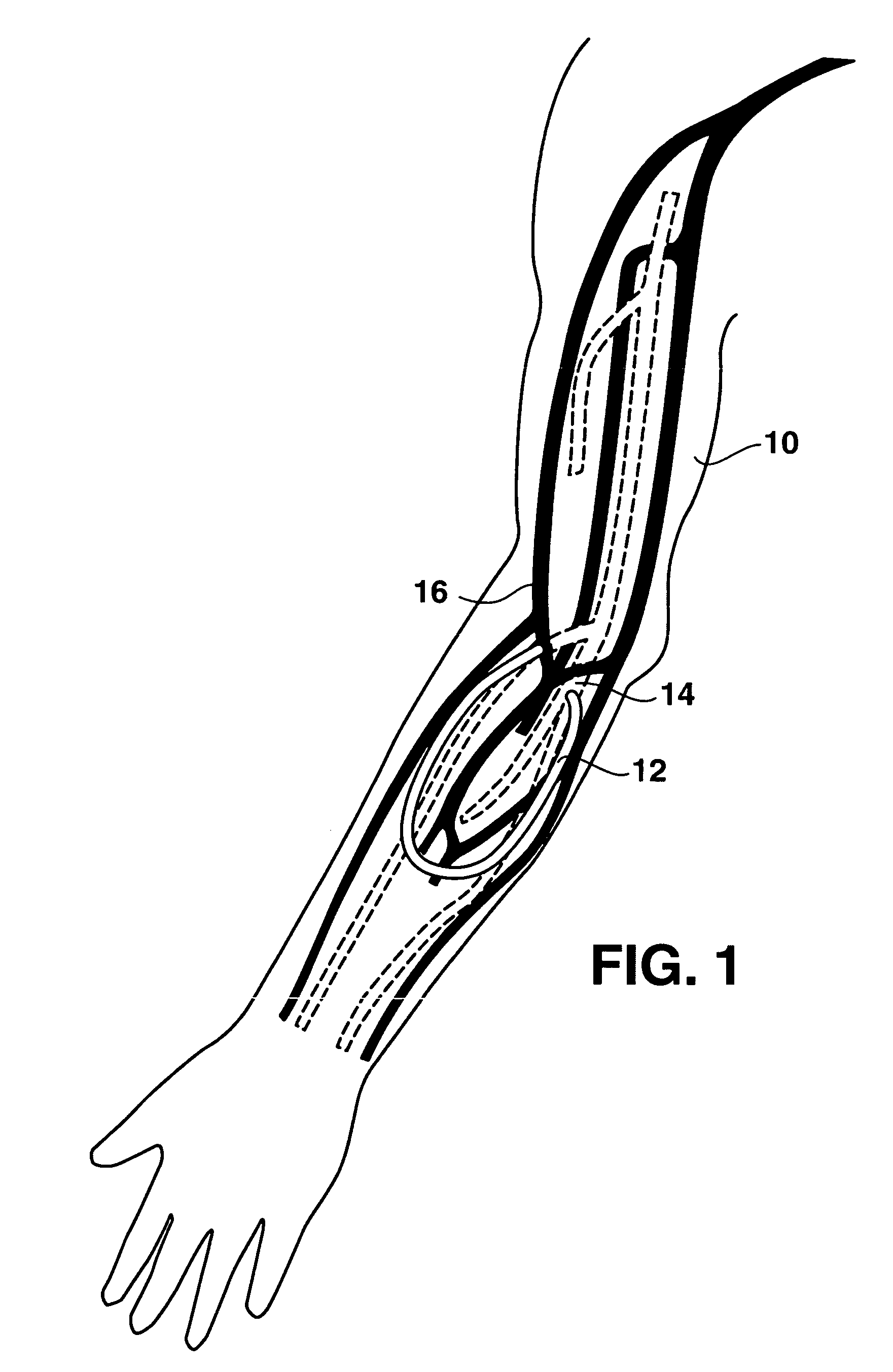 Arteriovenous access valve system and process