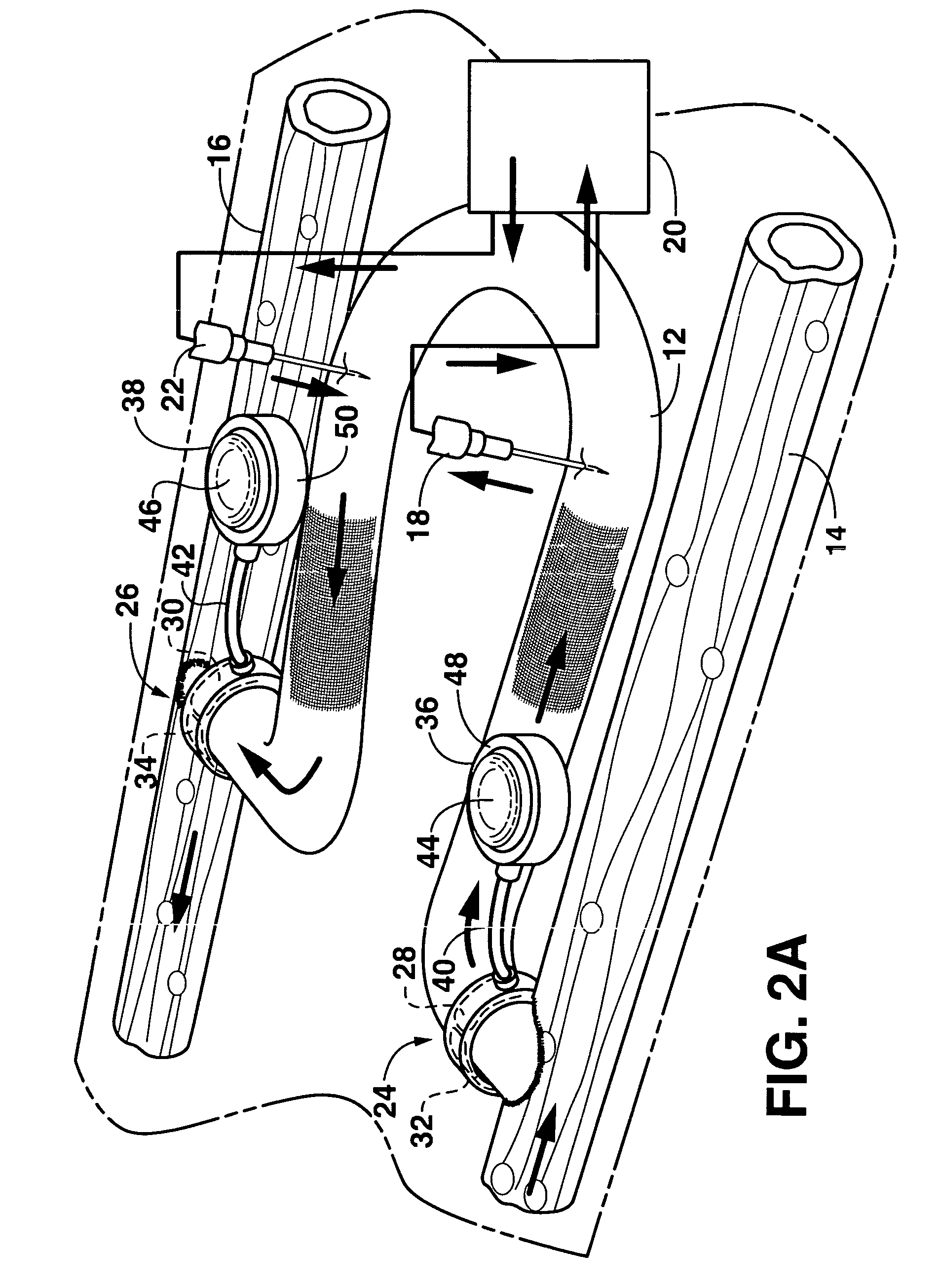 Arteriovenous access valve system and process