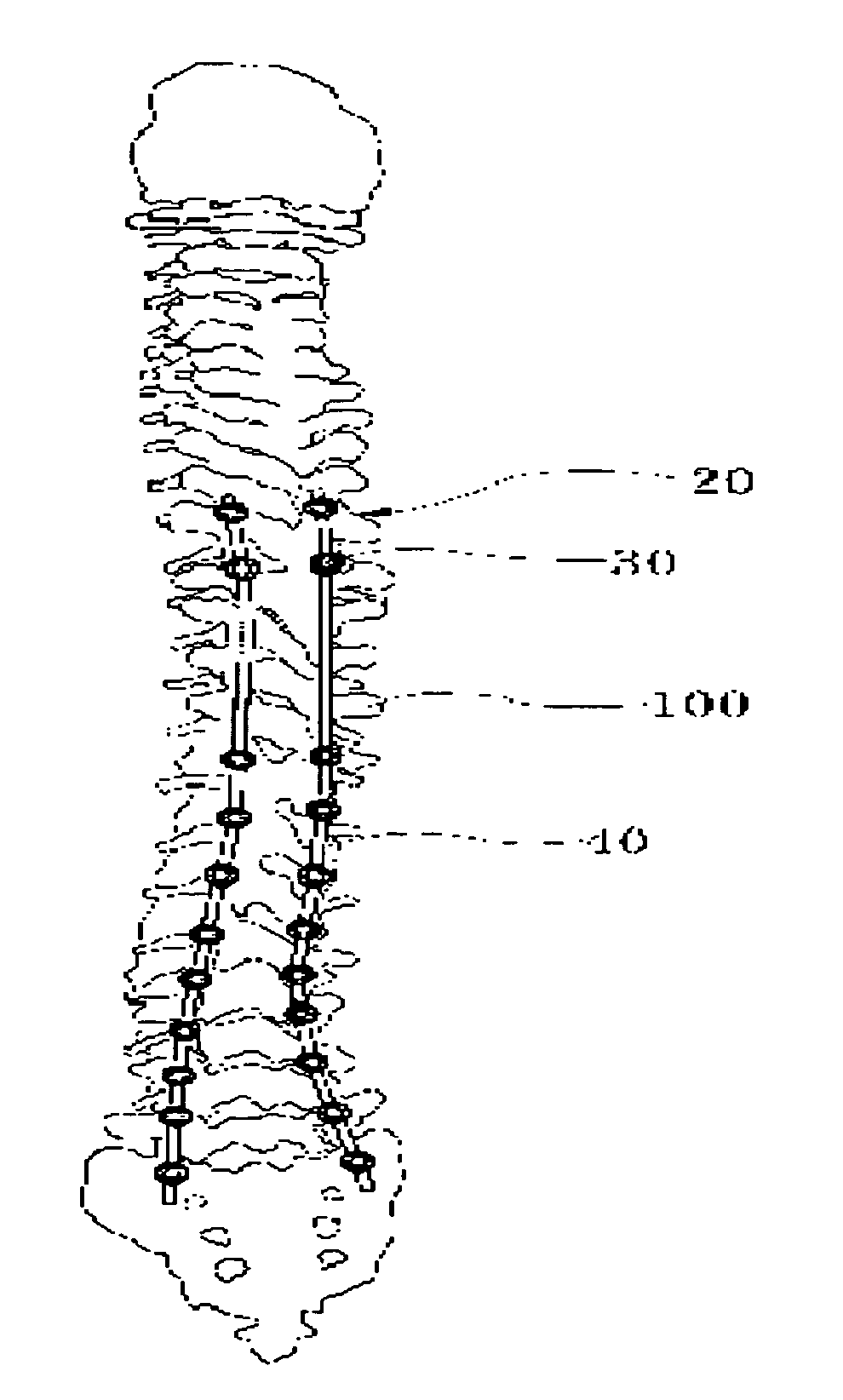 Spacer for use in a surgical operation for spinous process of spine