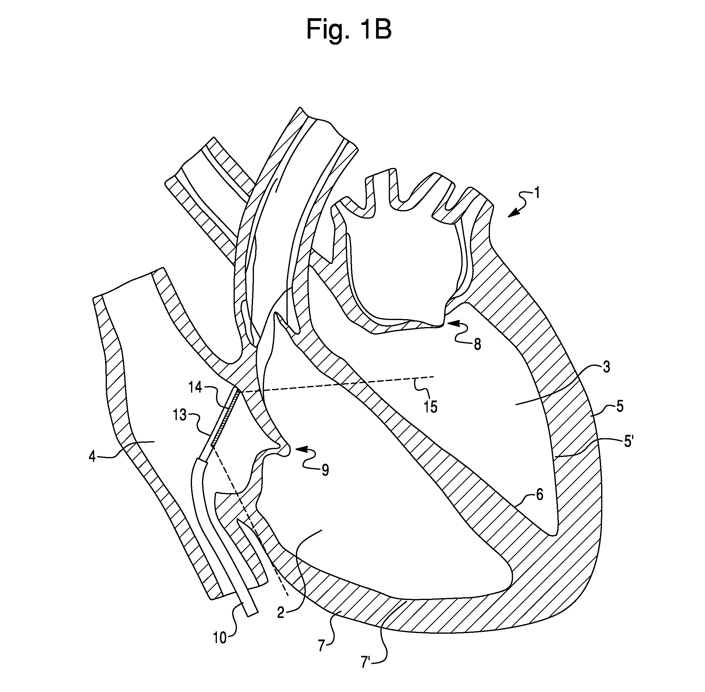 Method for Evaluating Regional Ventricular Function and Incoordinate Ventricular Contraction