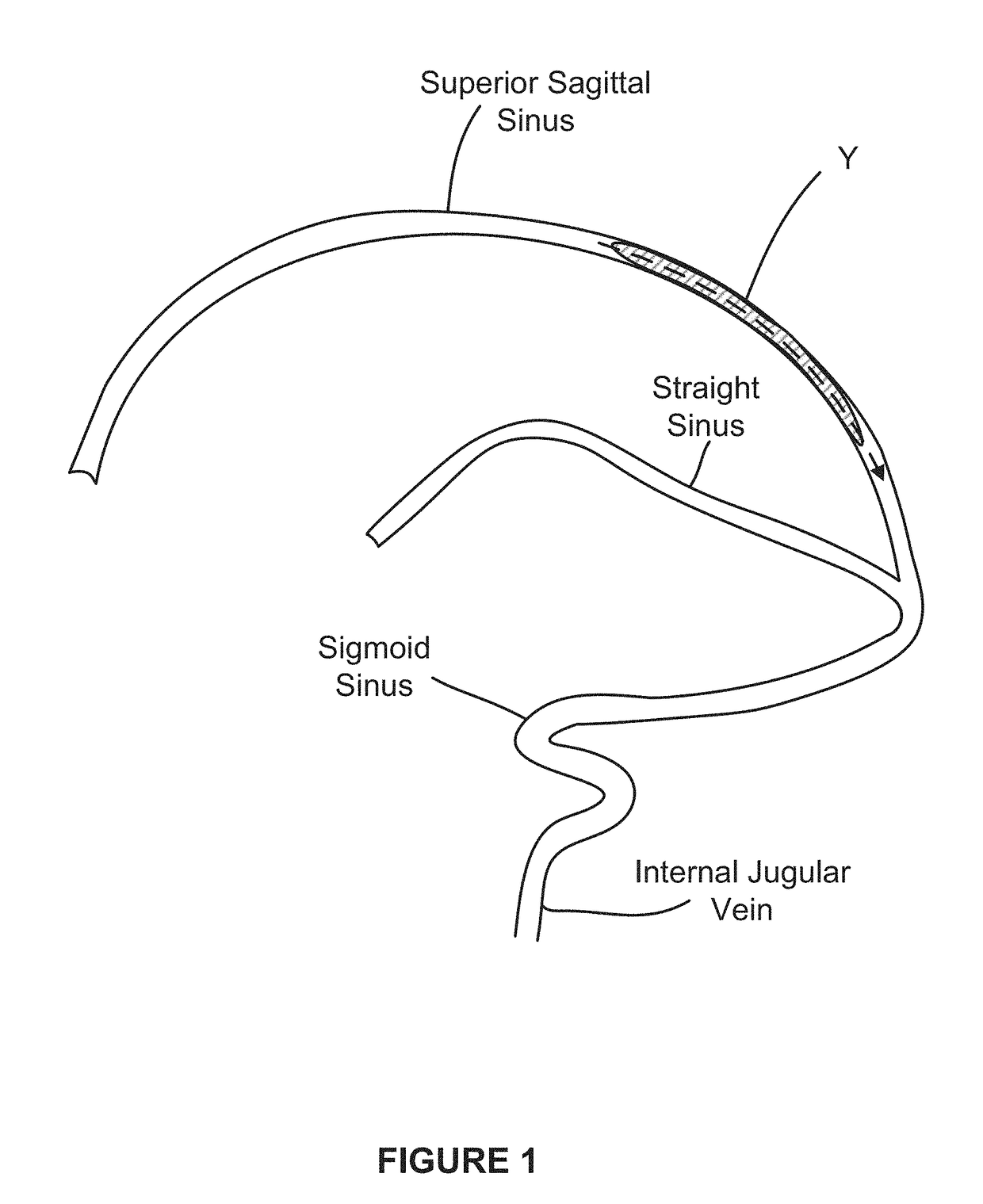 System and methods for accessing and treating cerebral venous sinus thrombosis