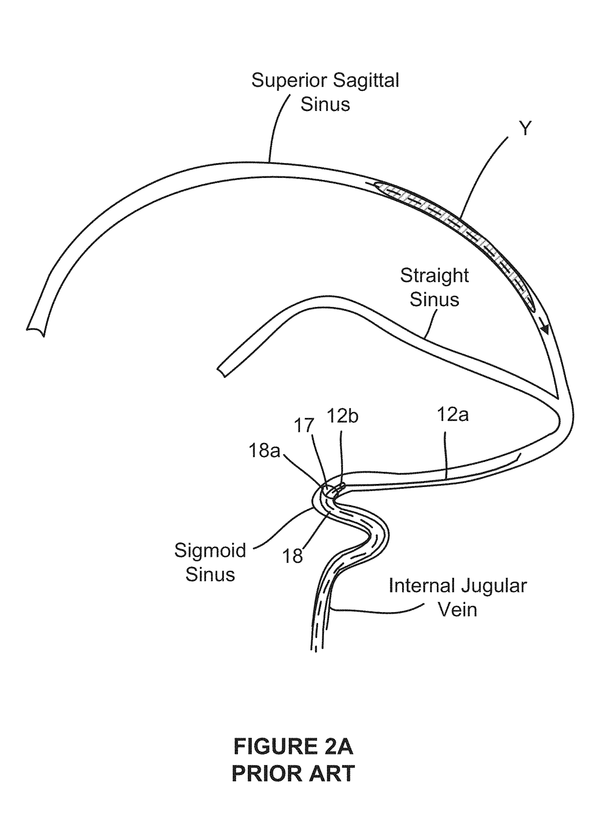 System and methods for accessing and treating cerebral venous sinus thrombosis