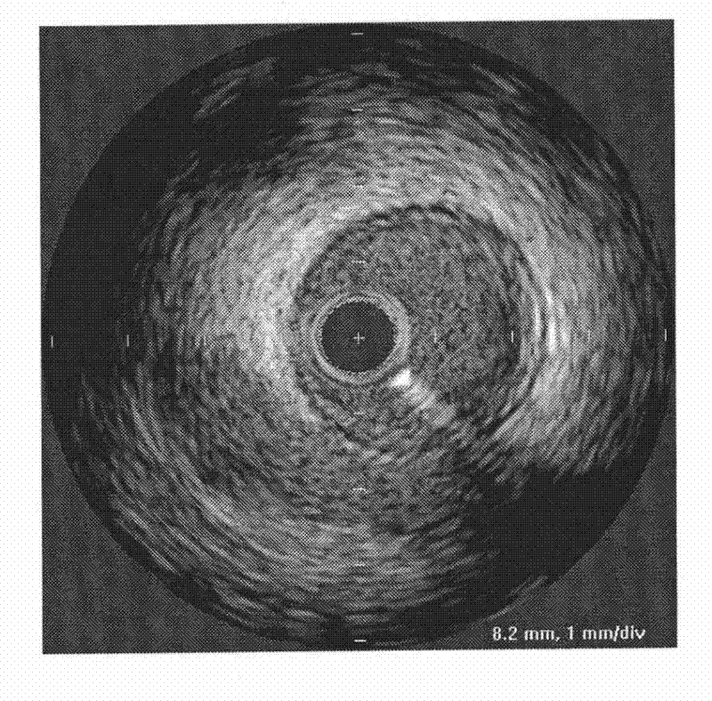 Elastic analysis method of vascular wall based on finite element deformation theory