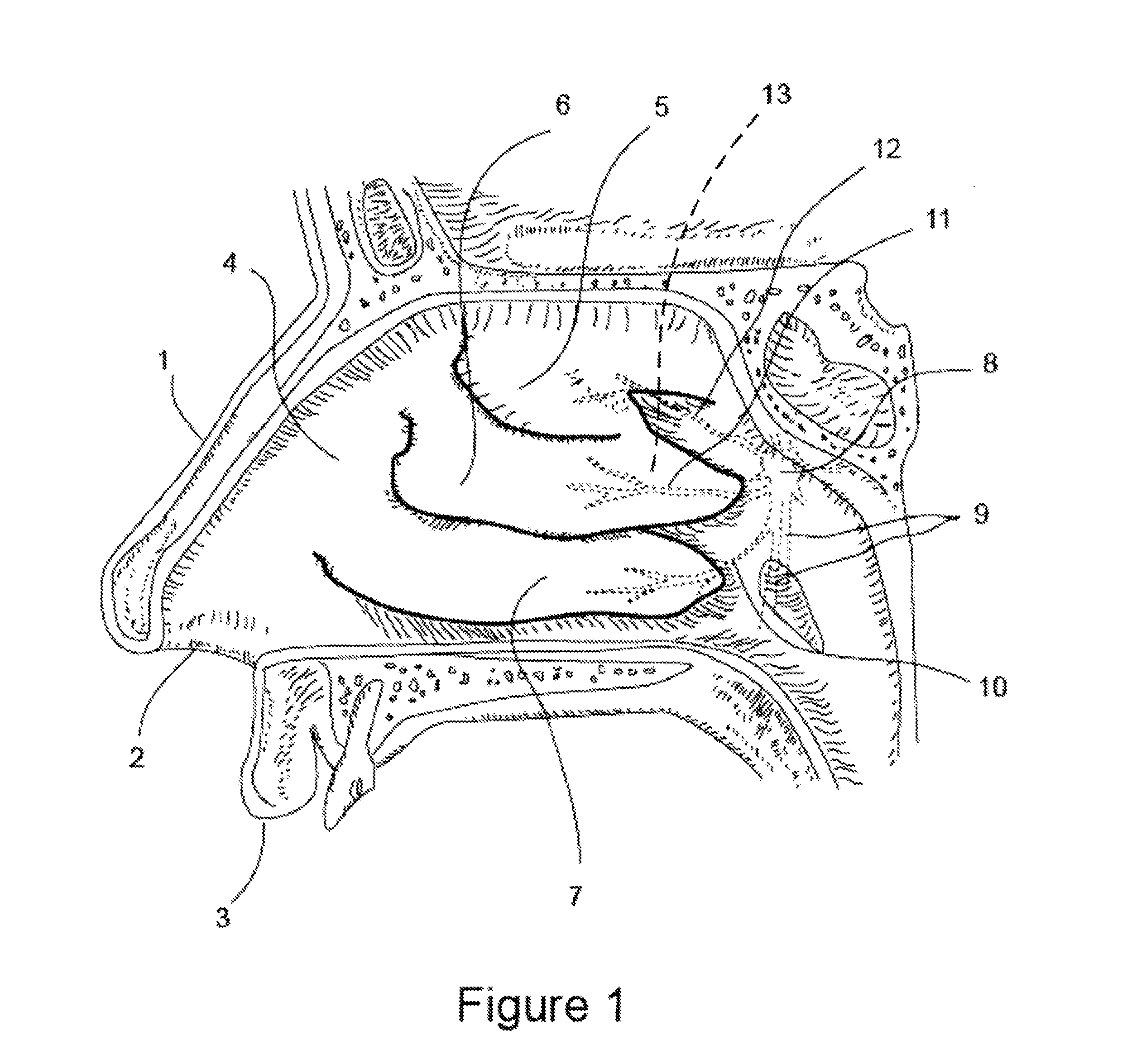 Apparatus and Methods for Treating Rhinitis