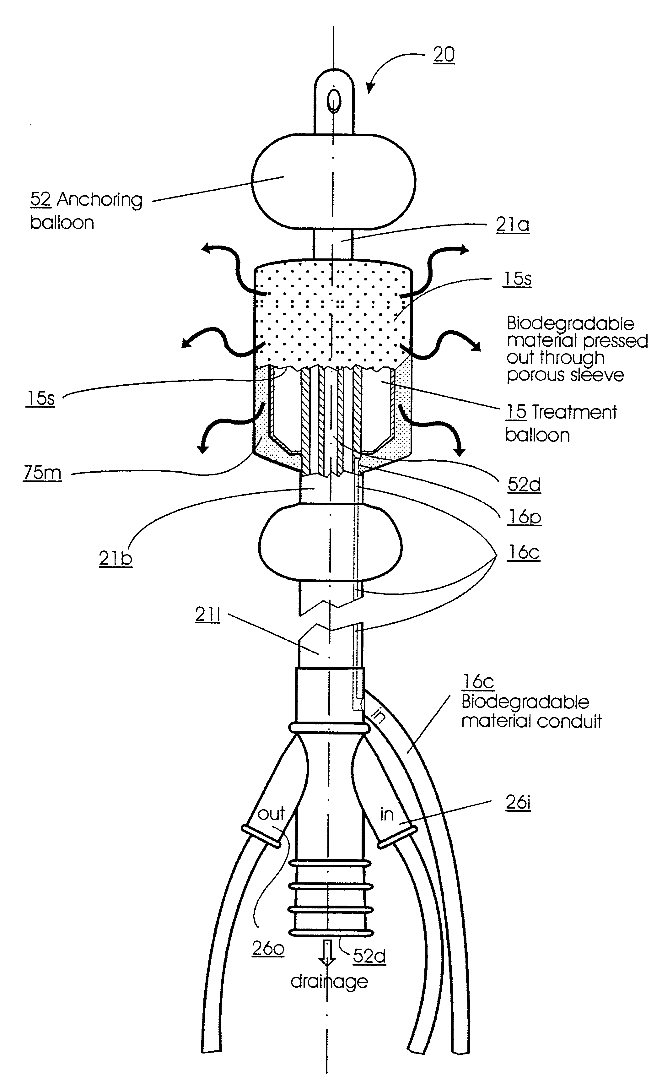 Methods for treating the prostate and inhibiting obstruction of the prostatic urethra using biodegradable stents