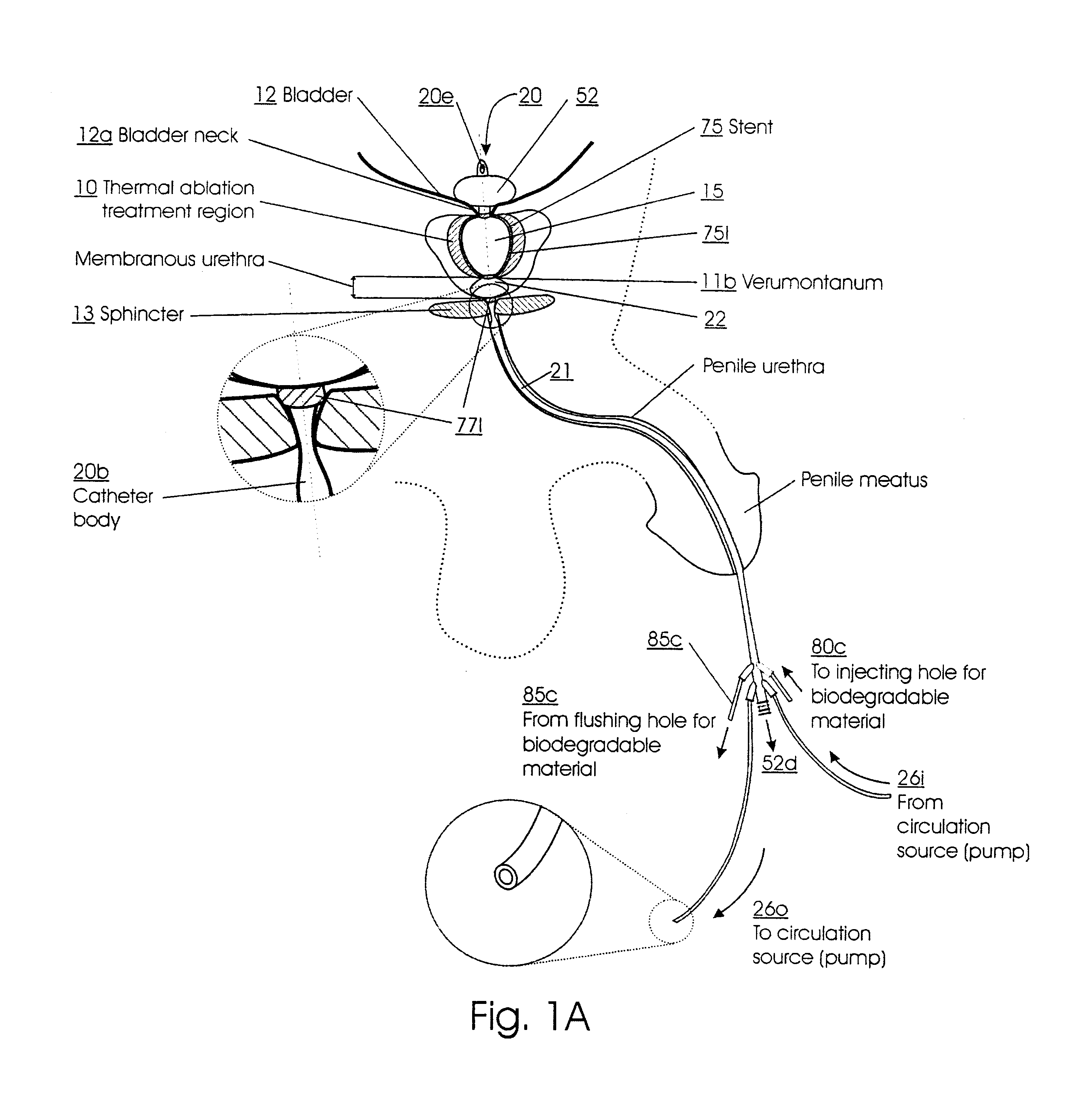 Methods for treating the prostate and inhibiting obstruction of the prostatic urethra using biodegradable stents