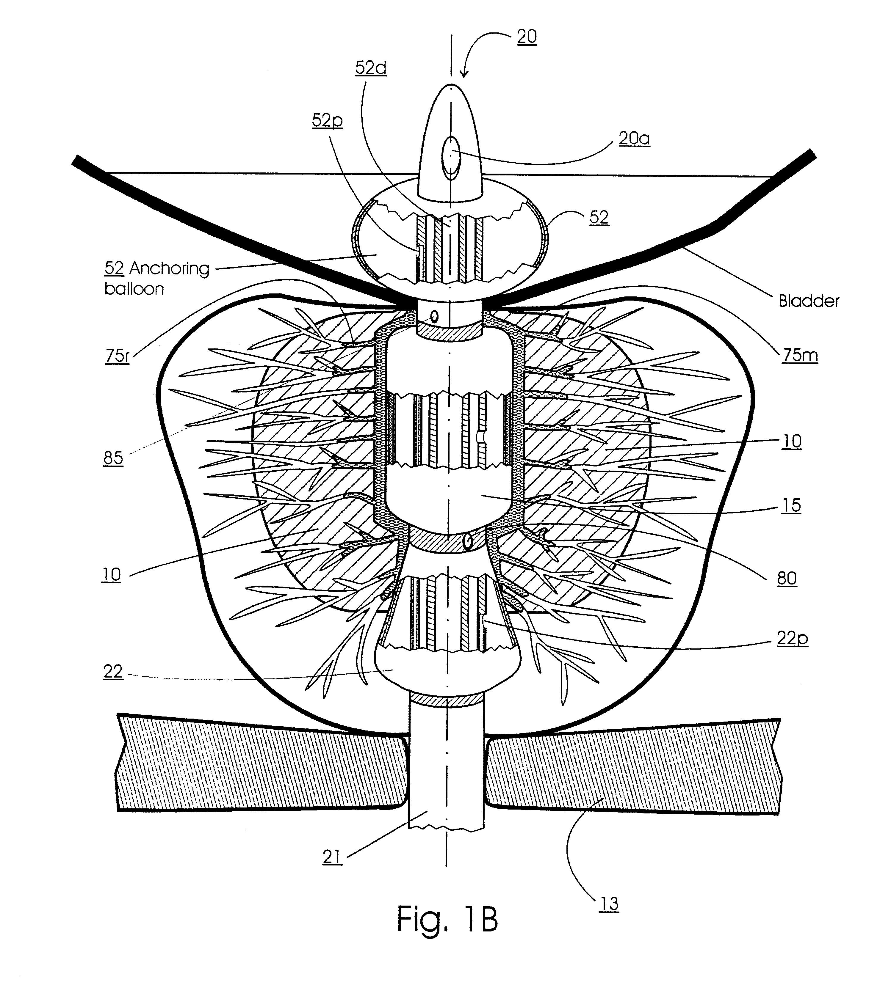 Methods for treating the prostate and inhibiting obstruction of the prostatic urethra using biodegradable stents