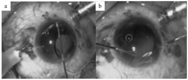 Pulling aid for fixing lens loop between sclera layers for seamless posterior chamber type intraocular lens and using method of pulling aid