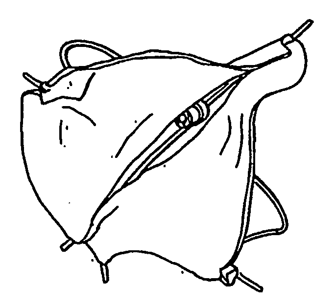 Venous bi-valve