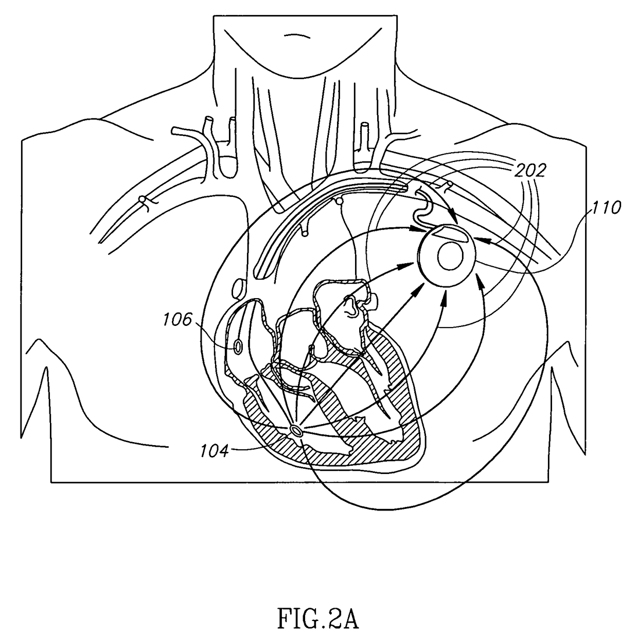 Bio-impedance apparatus and method