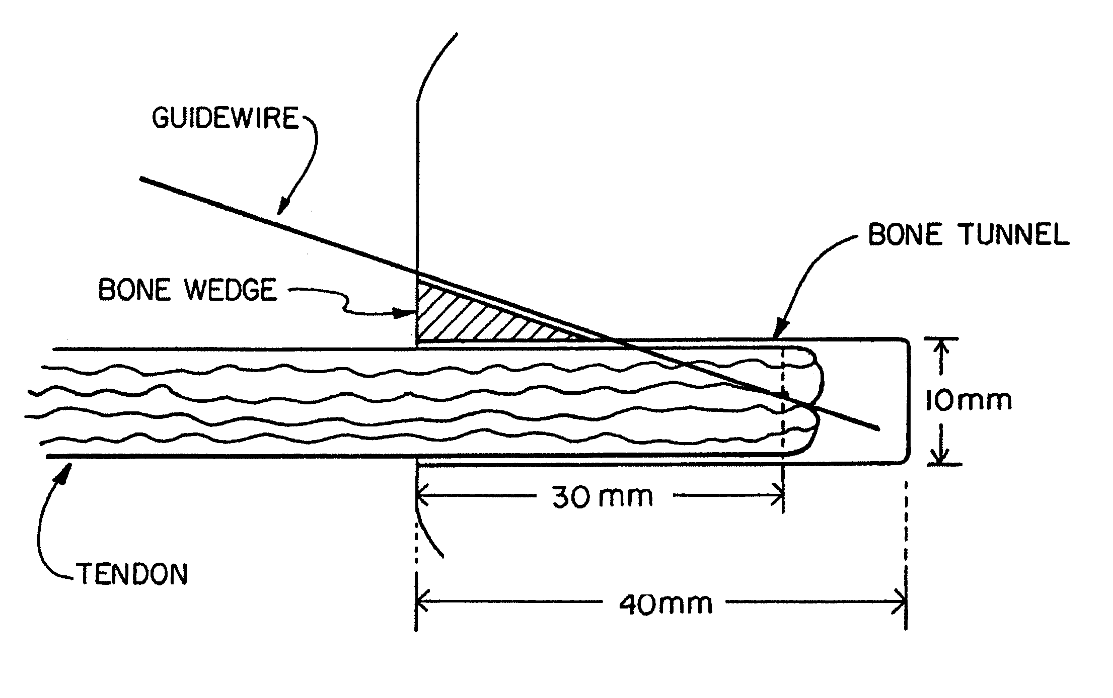 Method and apparatus for reconstructing a ligament