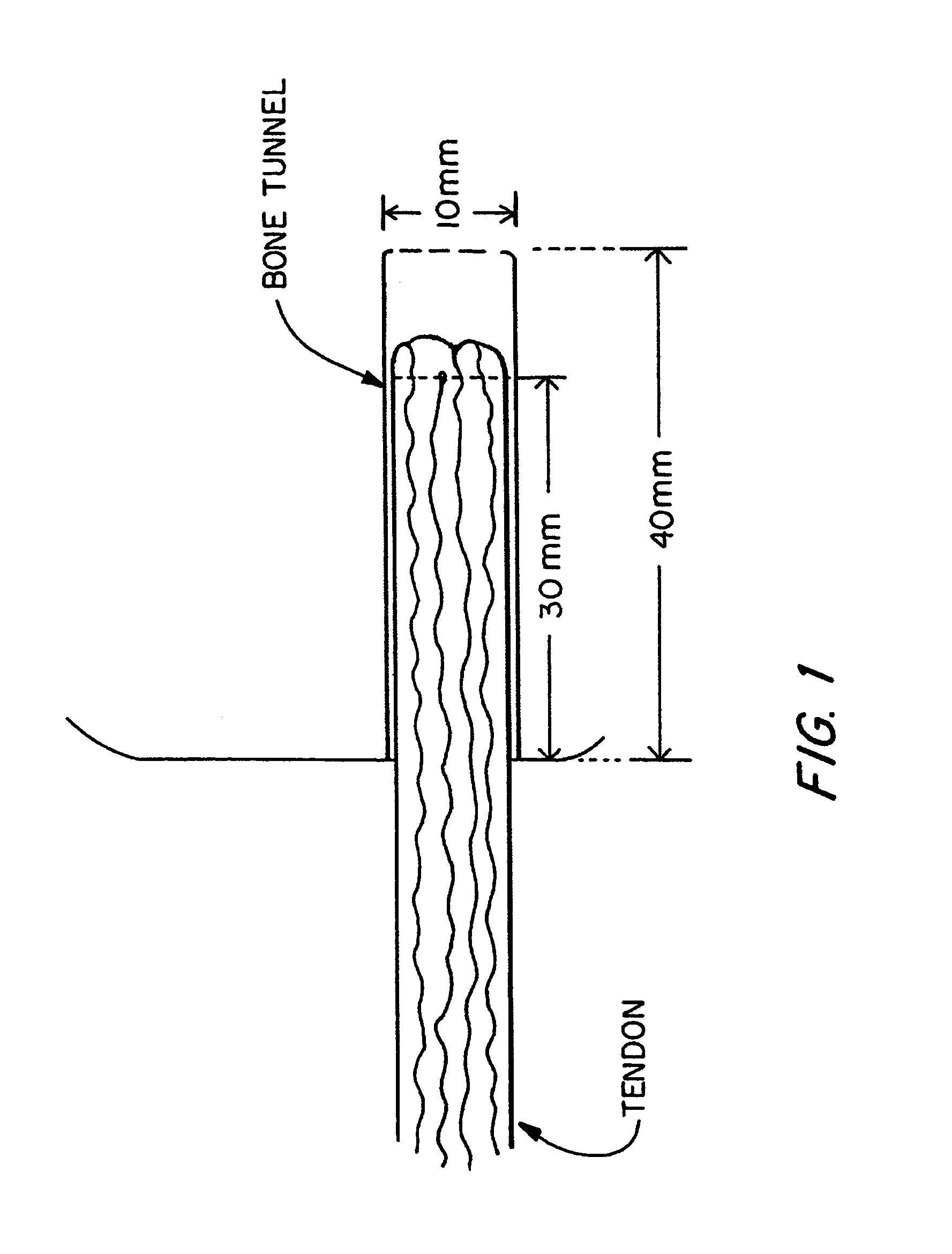 Method and apparatus for reconstructing a ligament