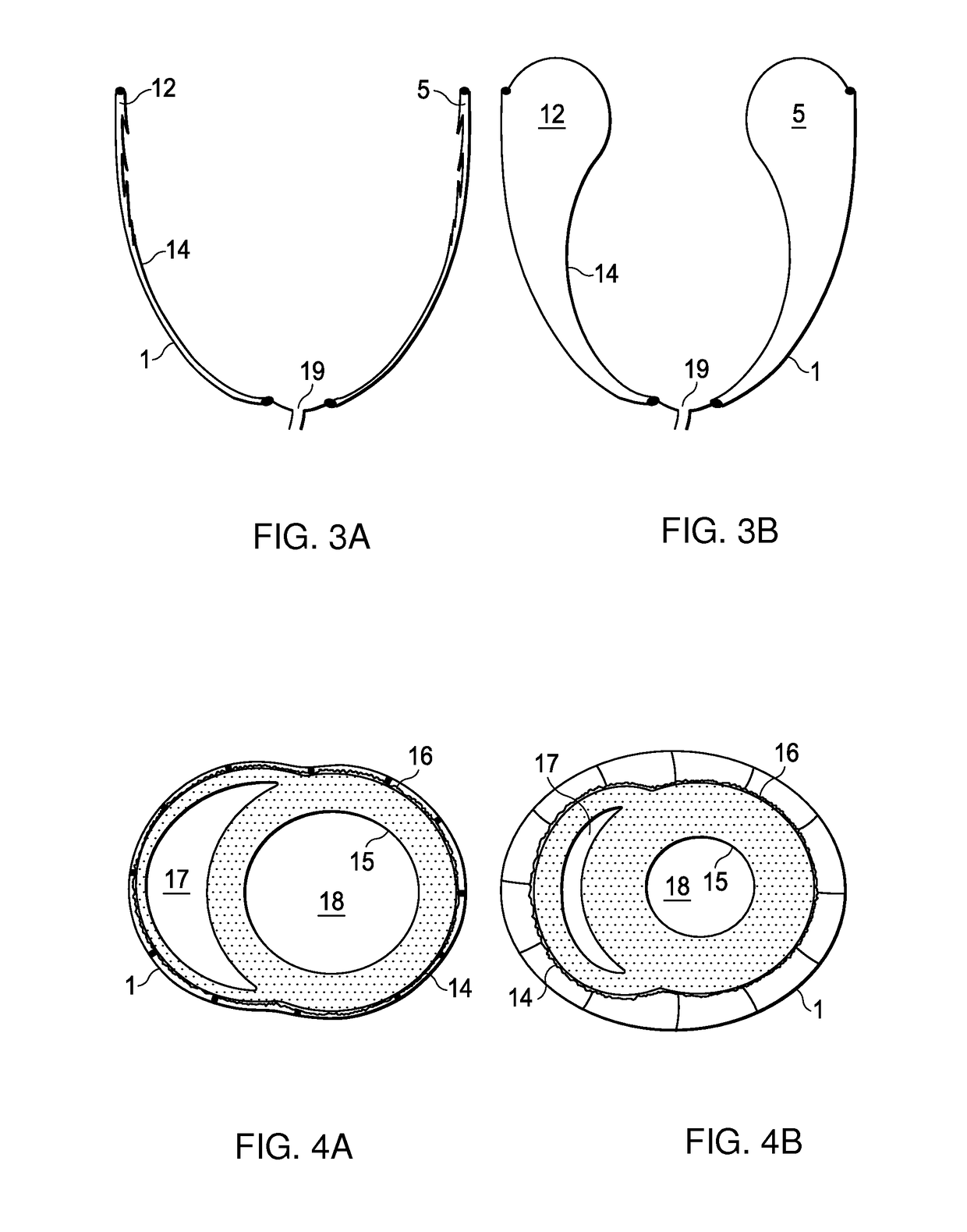 Diastolic recoil method and device for treatment of cardiac pathologies