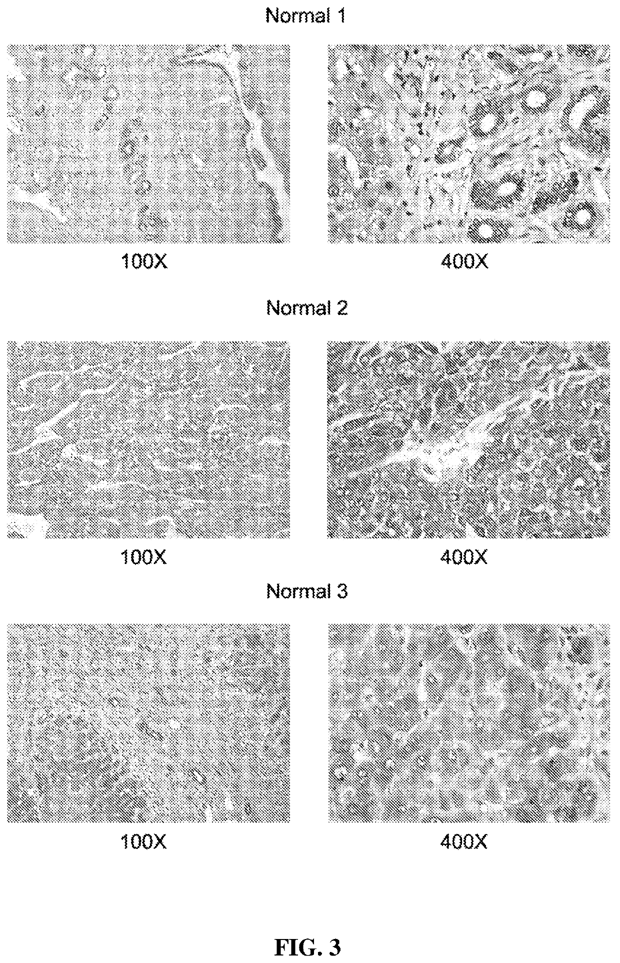 Inhibition of aminocylase 3 (AA3) in the treatment of cancer