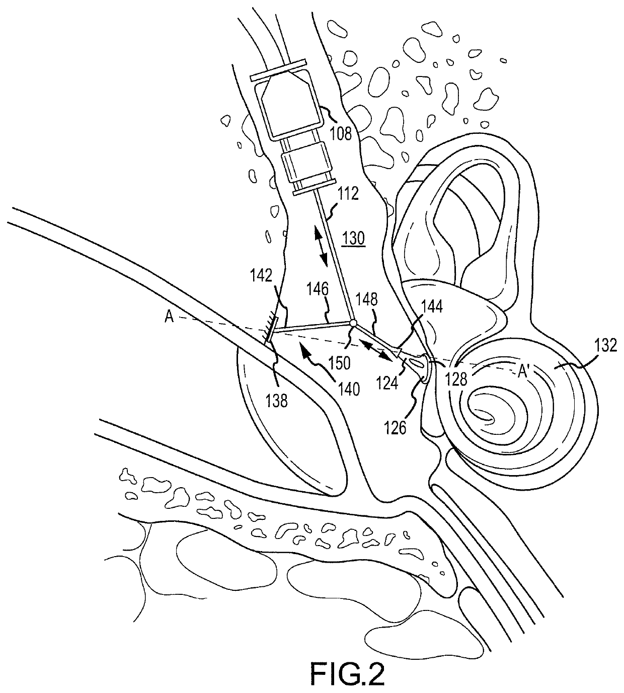 Spanning connector for implantable hearing instrument