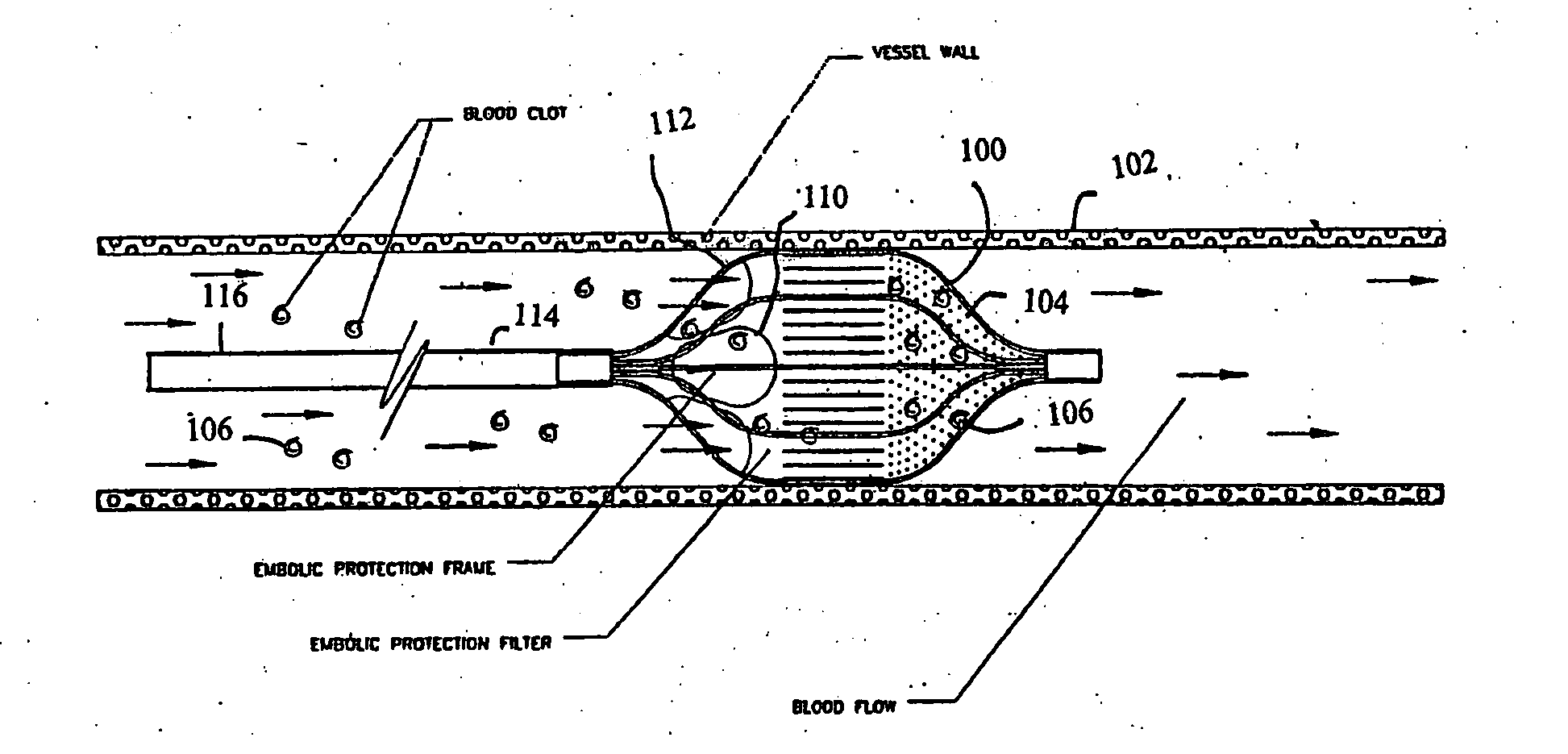 Shape memory thin film embolic protection device with frame