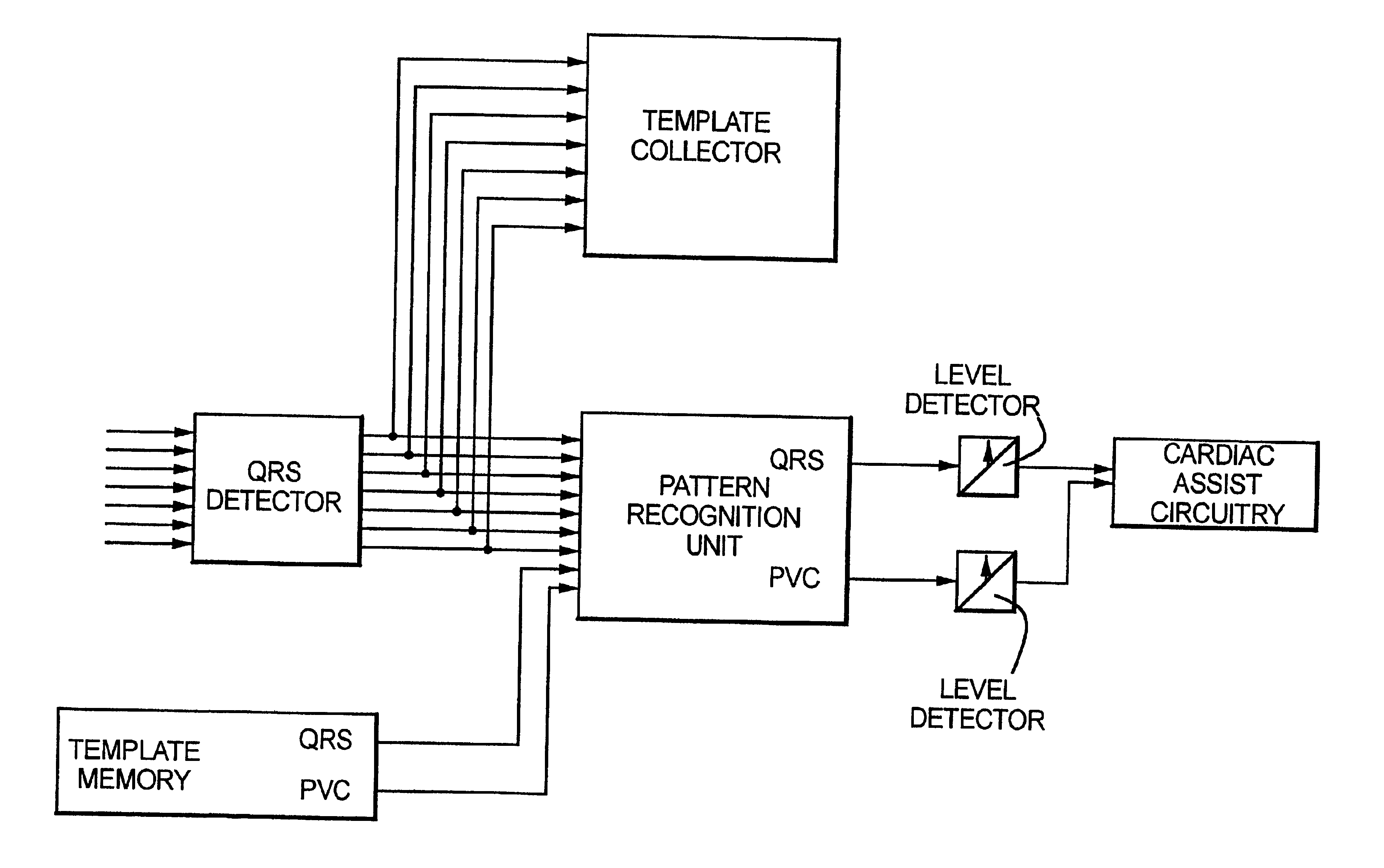 Method and circuit for detecting cardiac rhythm abnormalities by analyzing time differences between unipolar signals from a lead with a multi-electrode tip