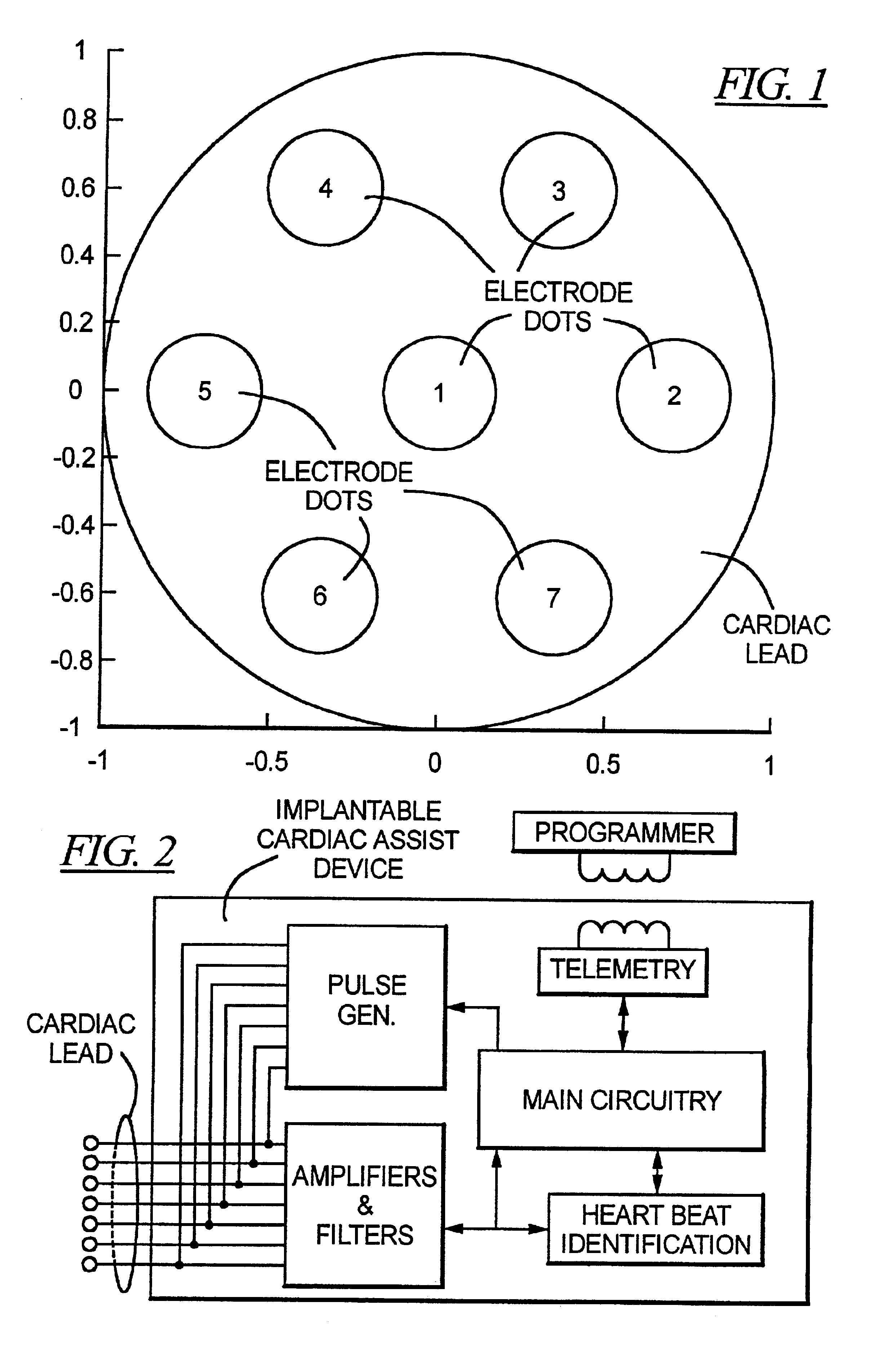 Method and circuit for detecting cardiac rhythm abnormalities by analyzing time differences between unipolar signals from a lead with a multi-electrode tip