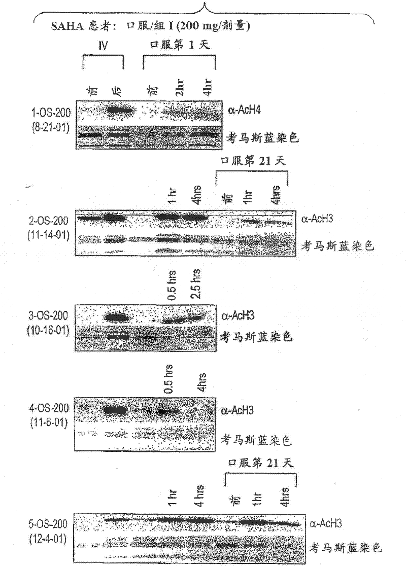 Method of treating cancer with HDAC inhibitors