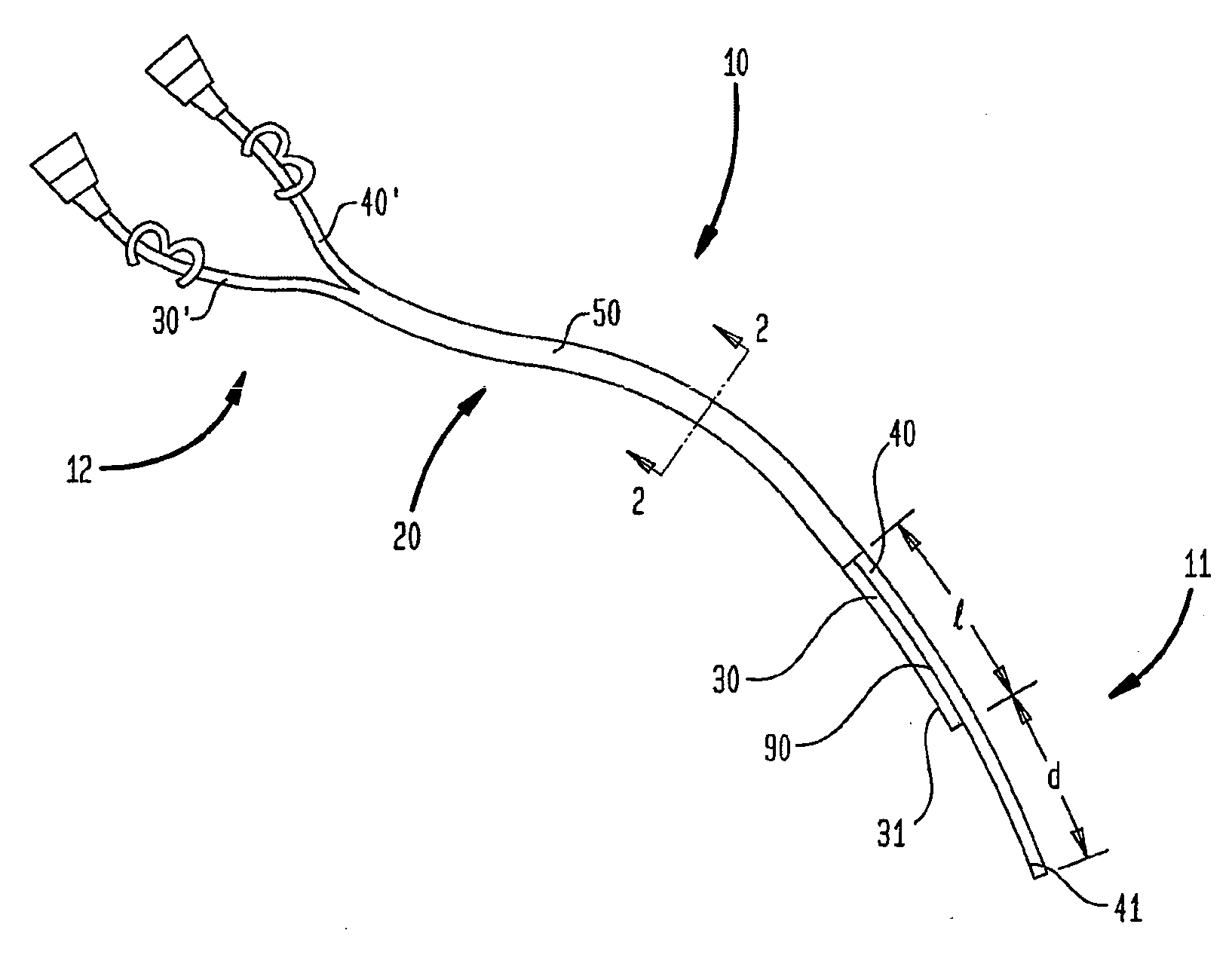 Splitable tip catheter with bioresorbable adhesive