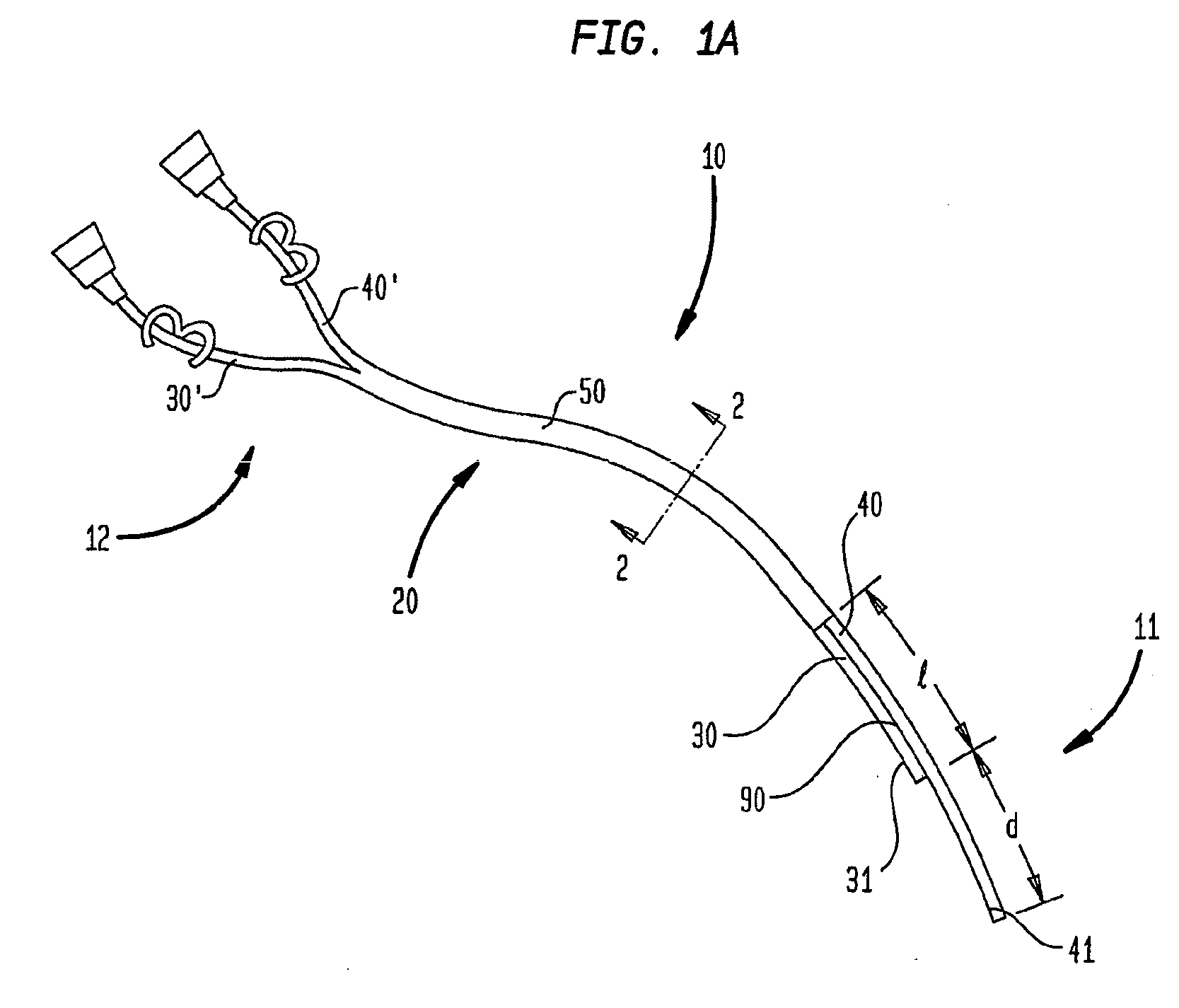 Splitable tip catheter with bioresorbable adhesive