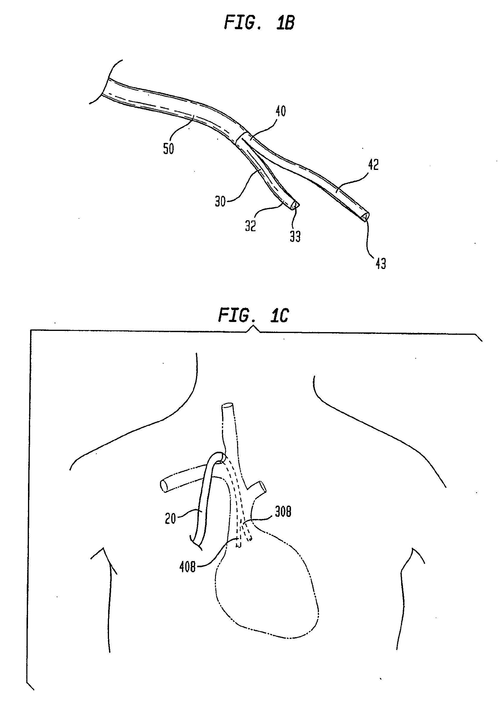 Splitable tip catheter with bioresorbable adhesive