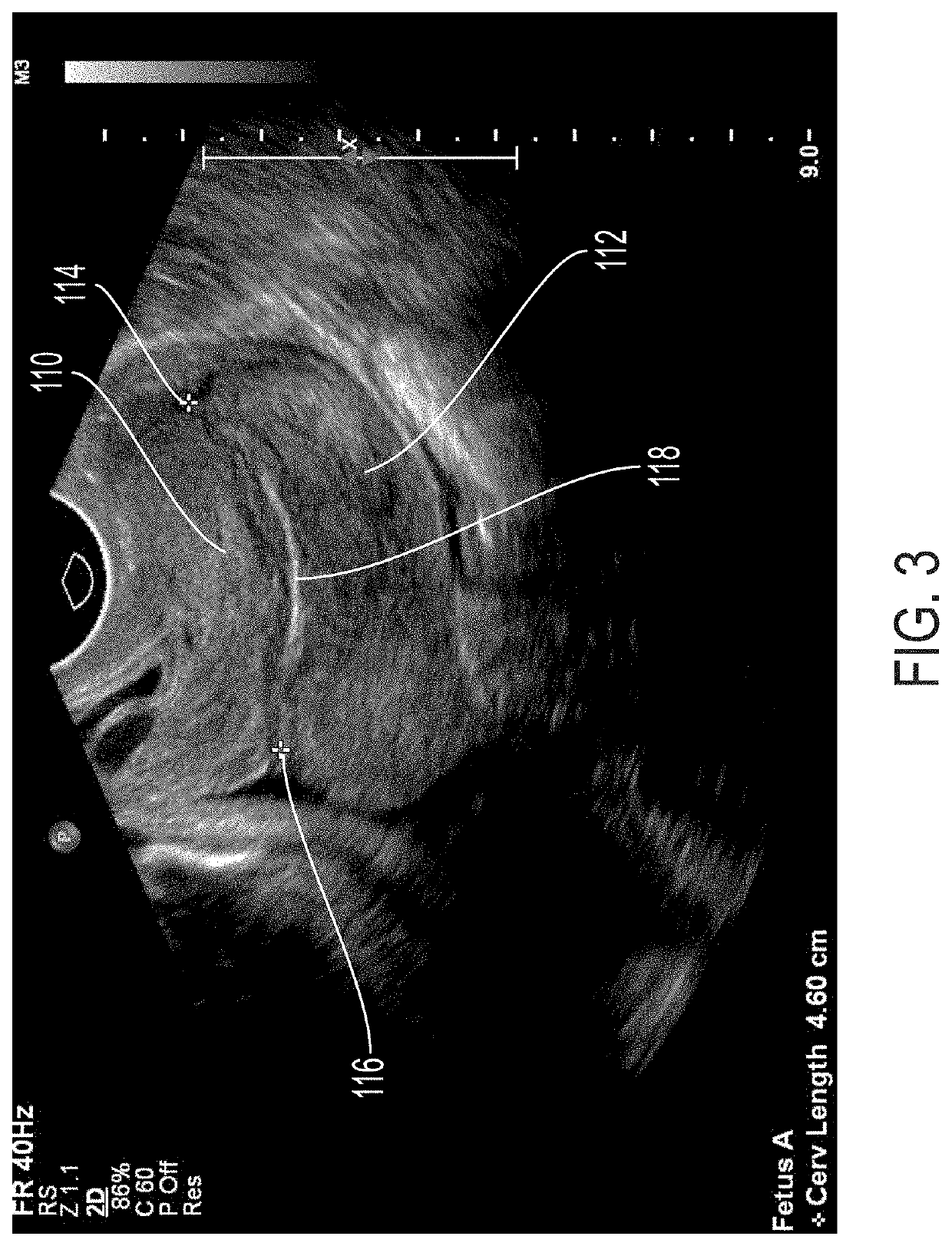 Pessary device and methods for preventing premature births