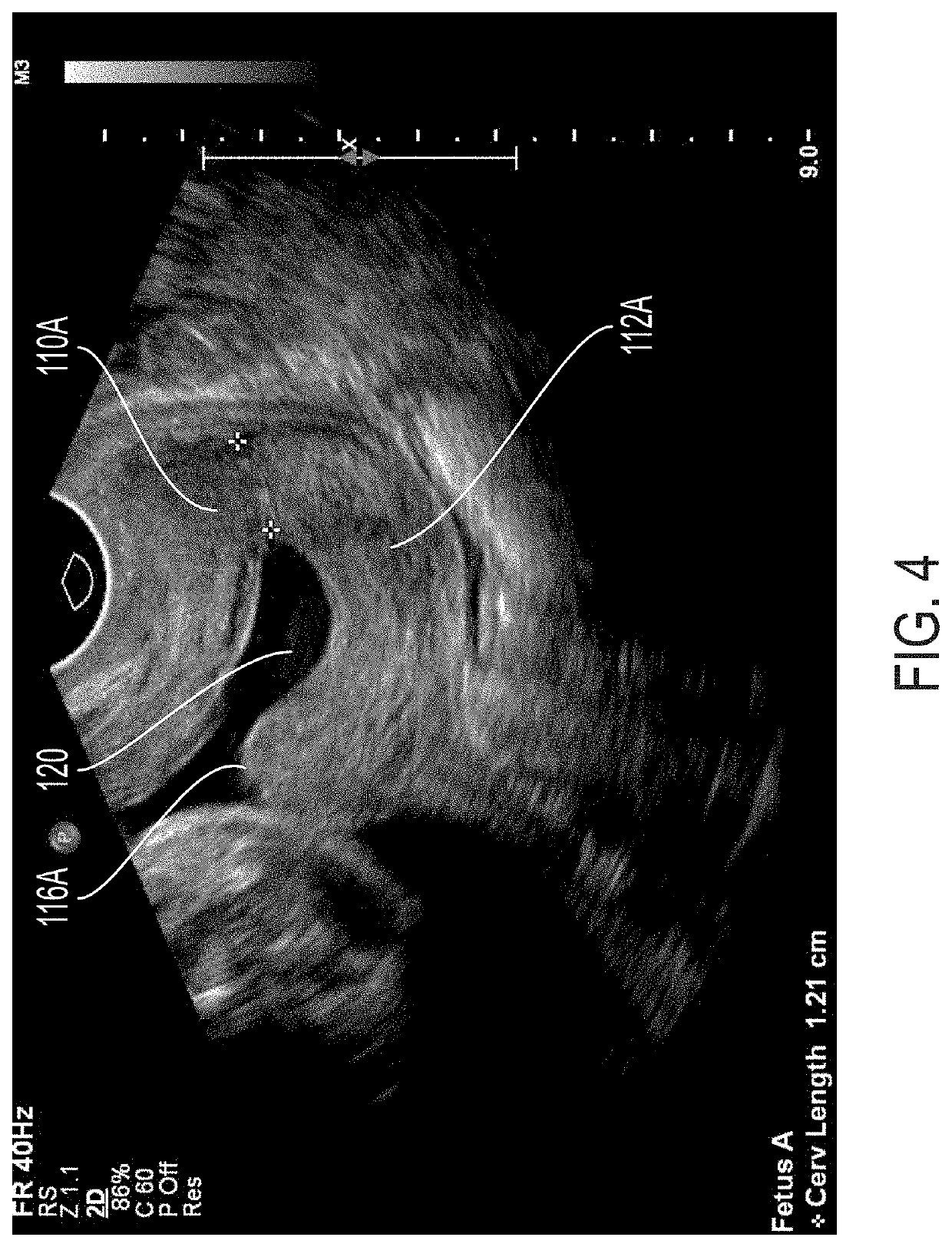 Pessary device and methods for preventing premature births