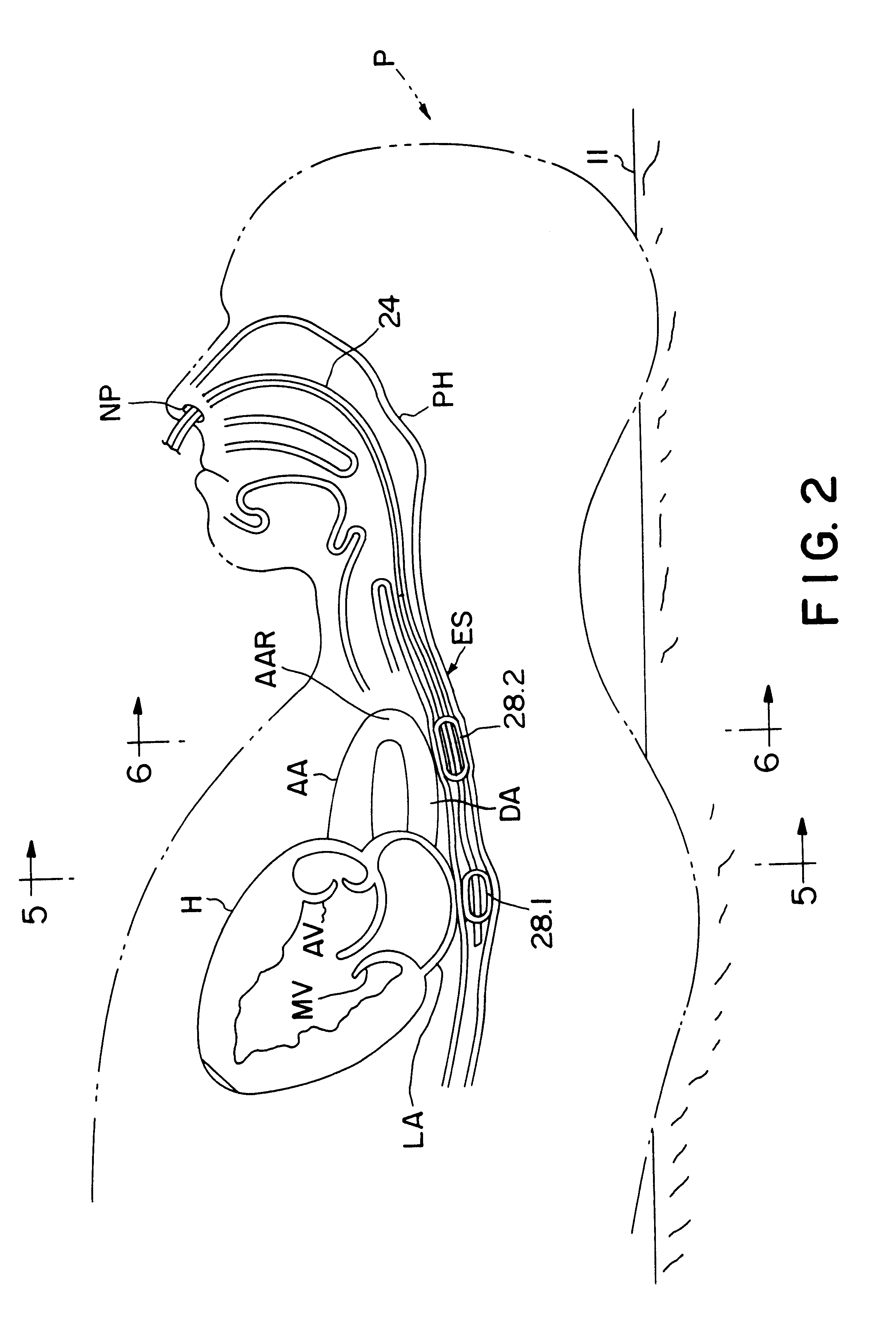 Method and apparatus for noninvasive determination of cardiac performance parameters