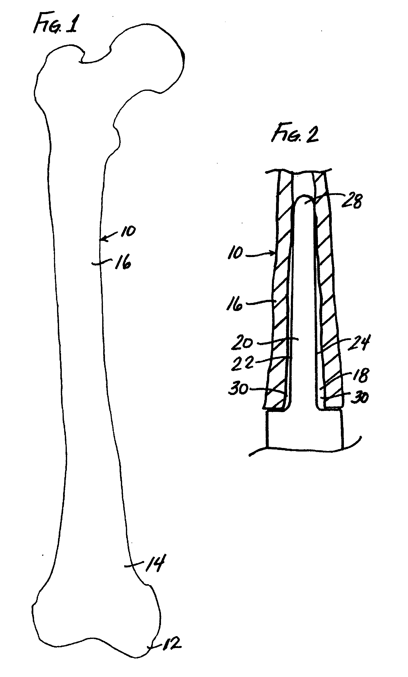 Modular diaphyseal and collar implant