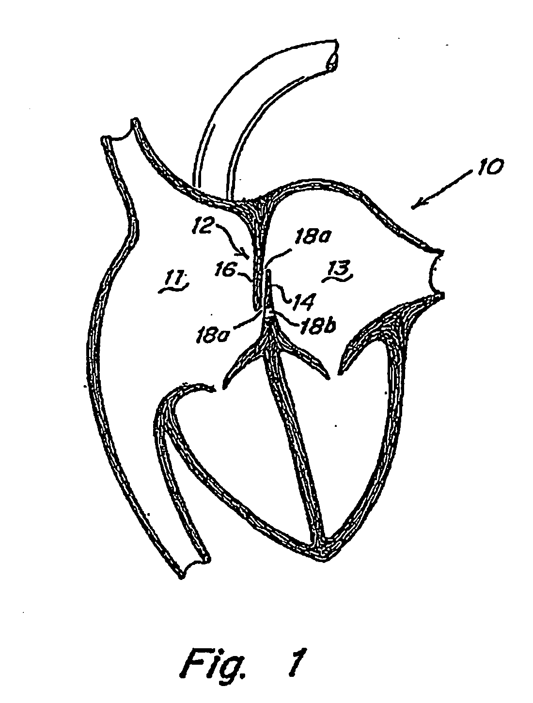 Deformable flap catch mechanism for occluder device