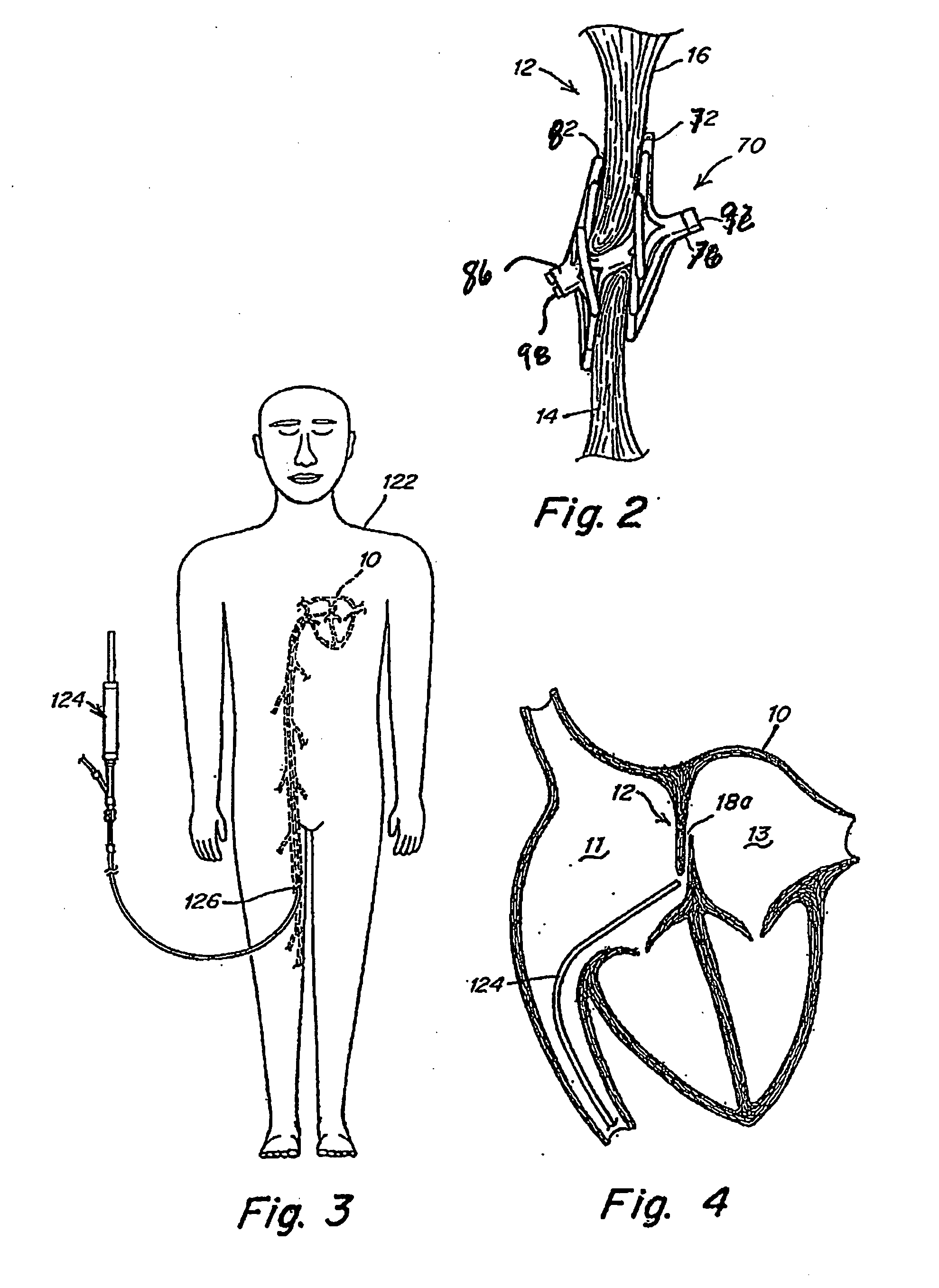 Deformable flap catch mechanism for occluder device