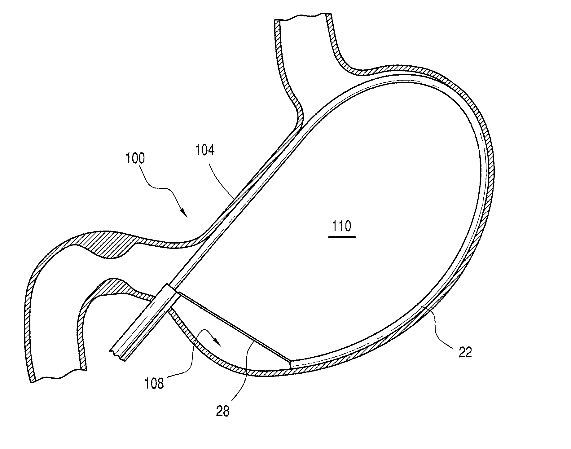 Gastric coil manipulator