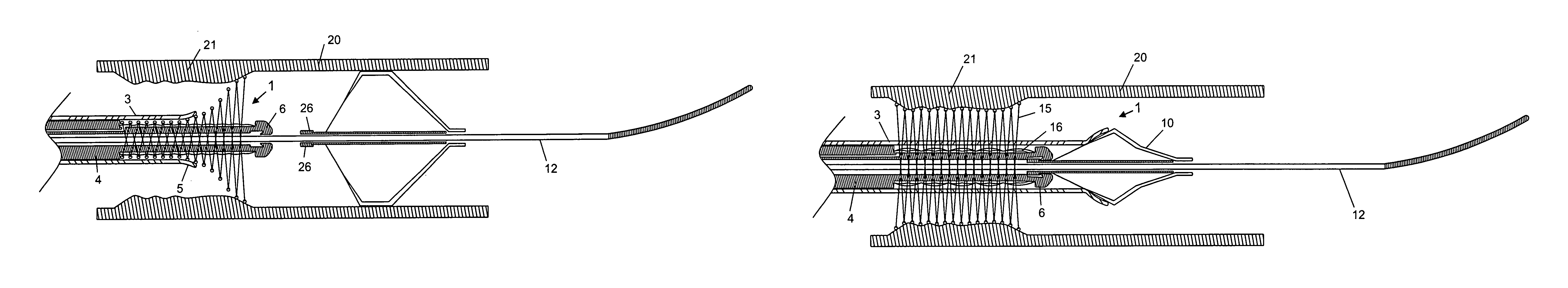 Embolic protection system