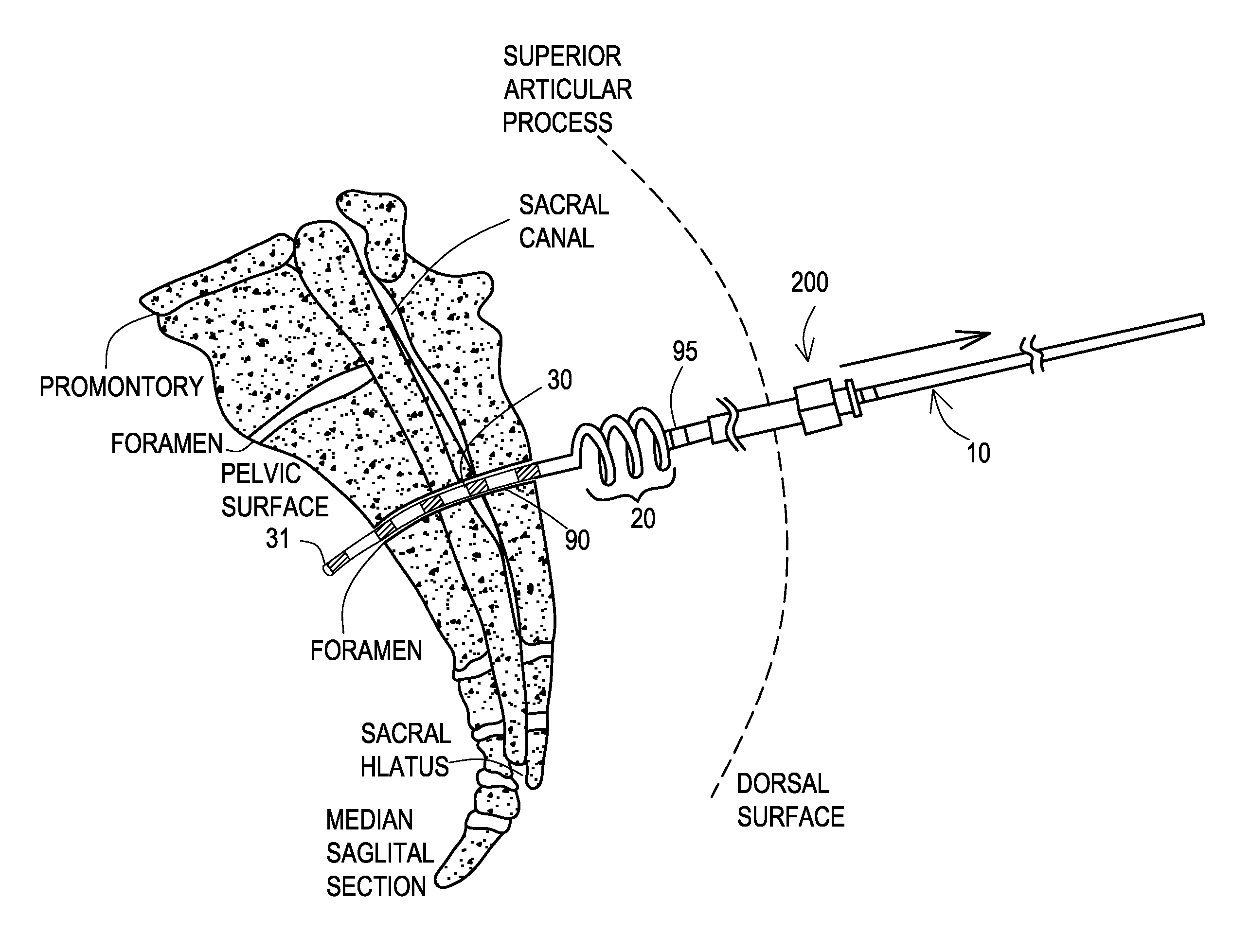 Implantable medical electrical stimulation lead fixation method and apparatus