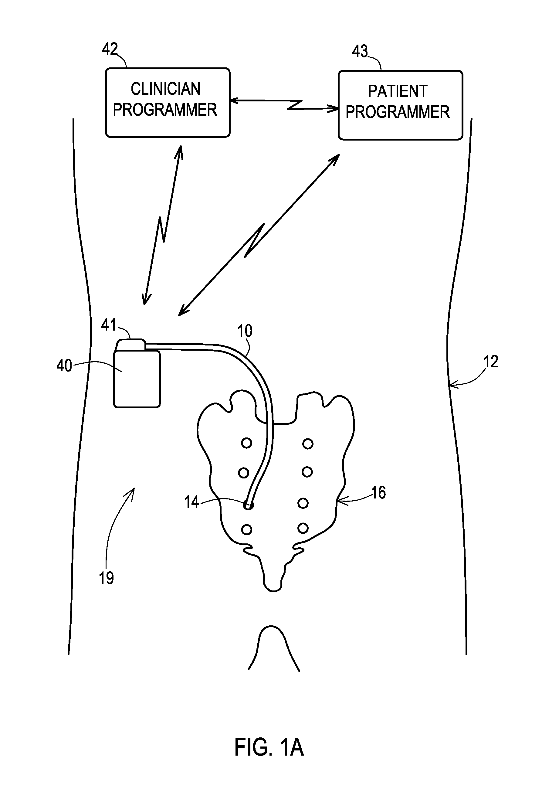 Implantable medical electrical stimulation lead fixation method and apparatus