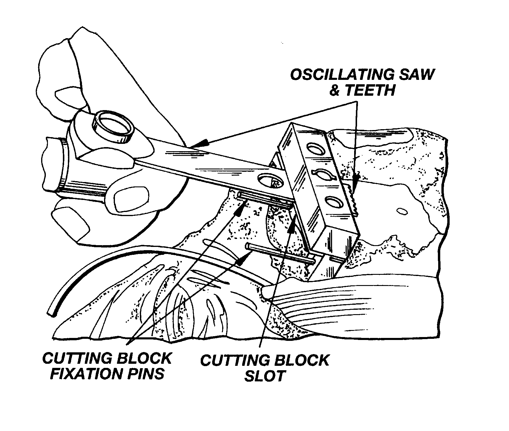 Methods and apparatus for pinplasty bone resection