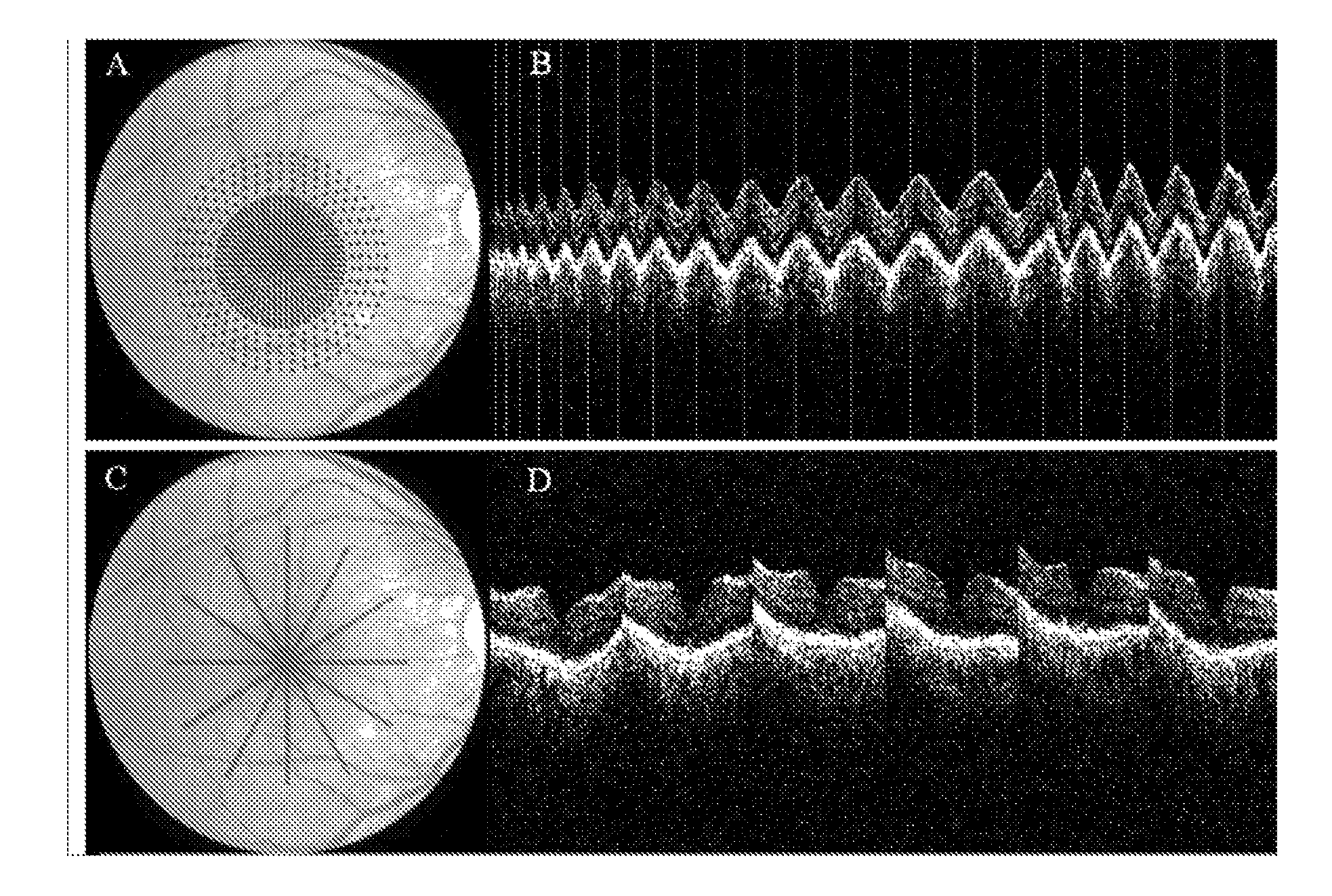 Mapping and diagnosis of macular edema by optical coherence tomography