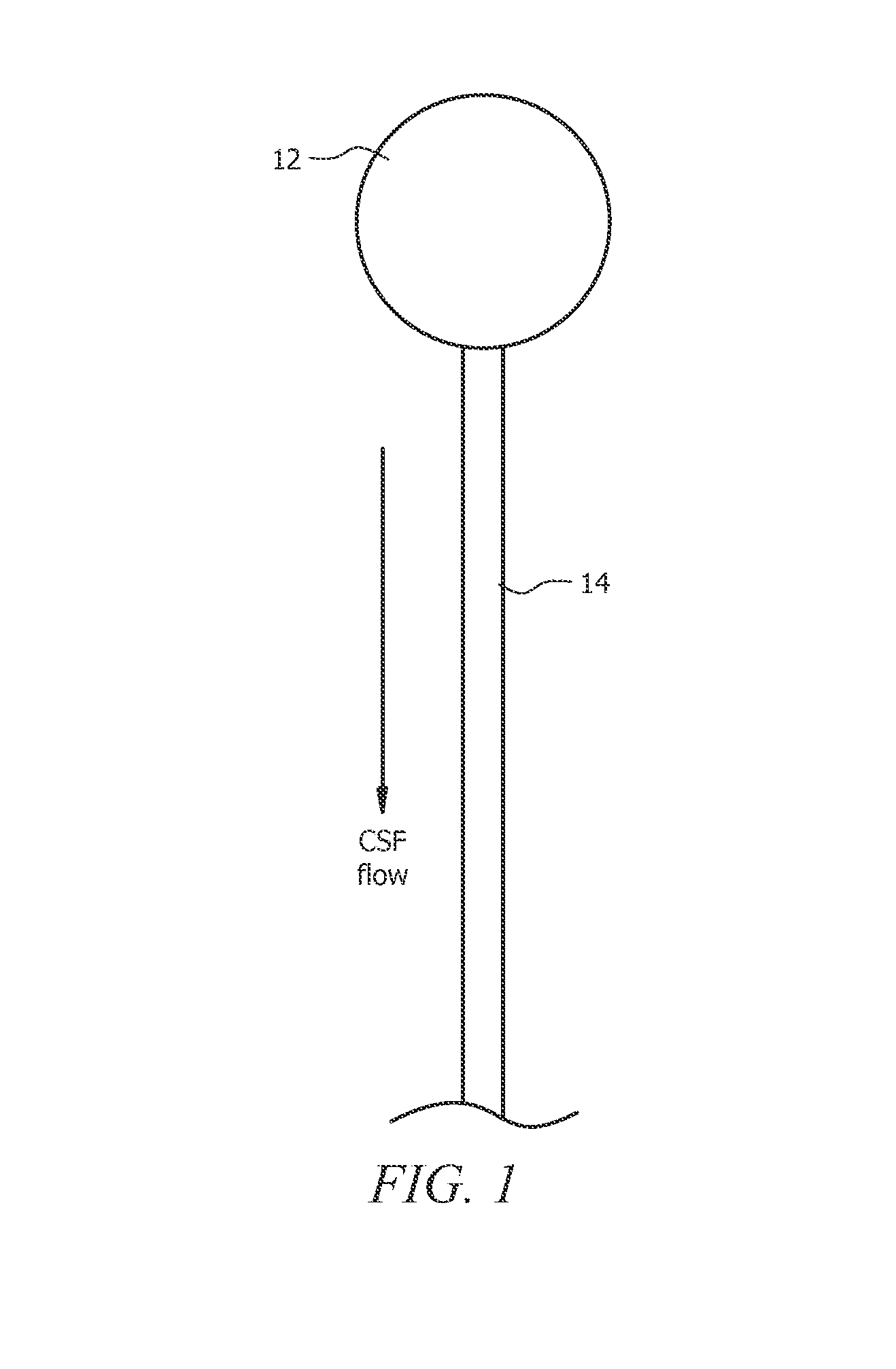 Shunt catheter system