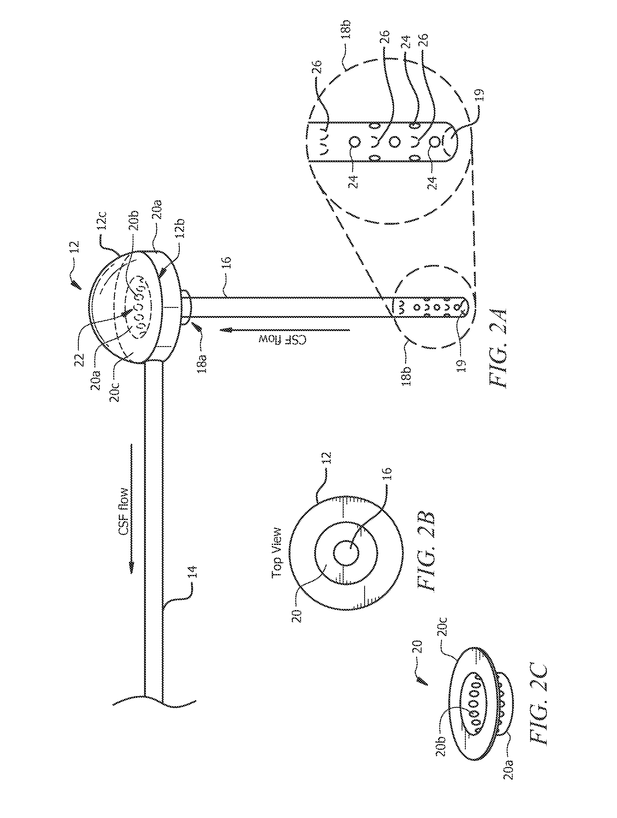 Shunt catheter system