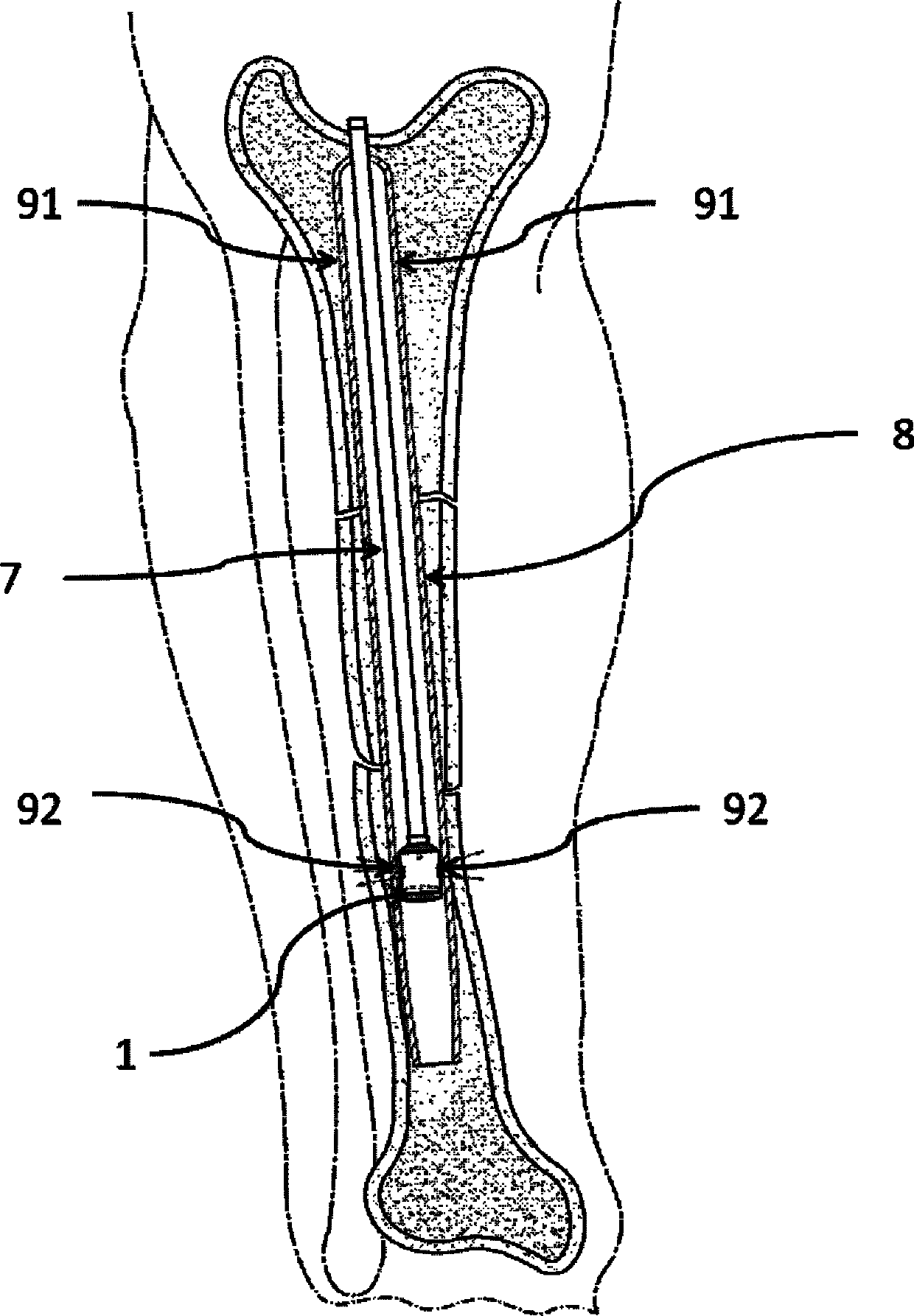 Side lighting device engaged with medullary cavity guide needle