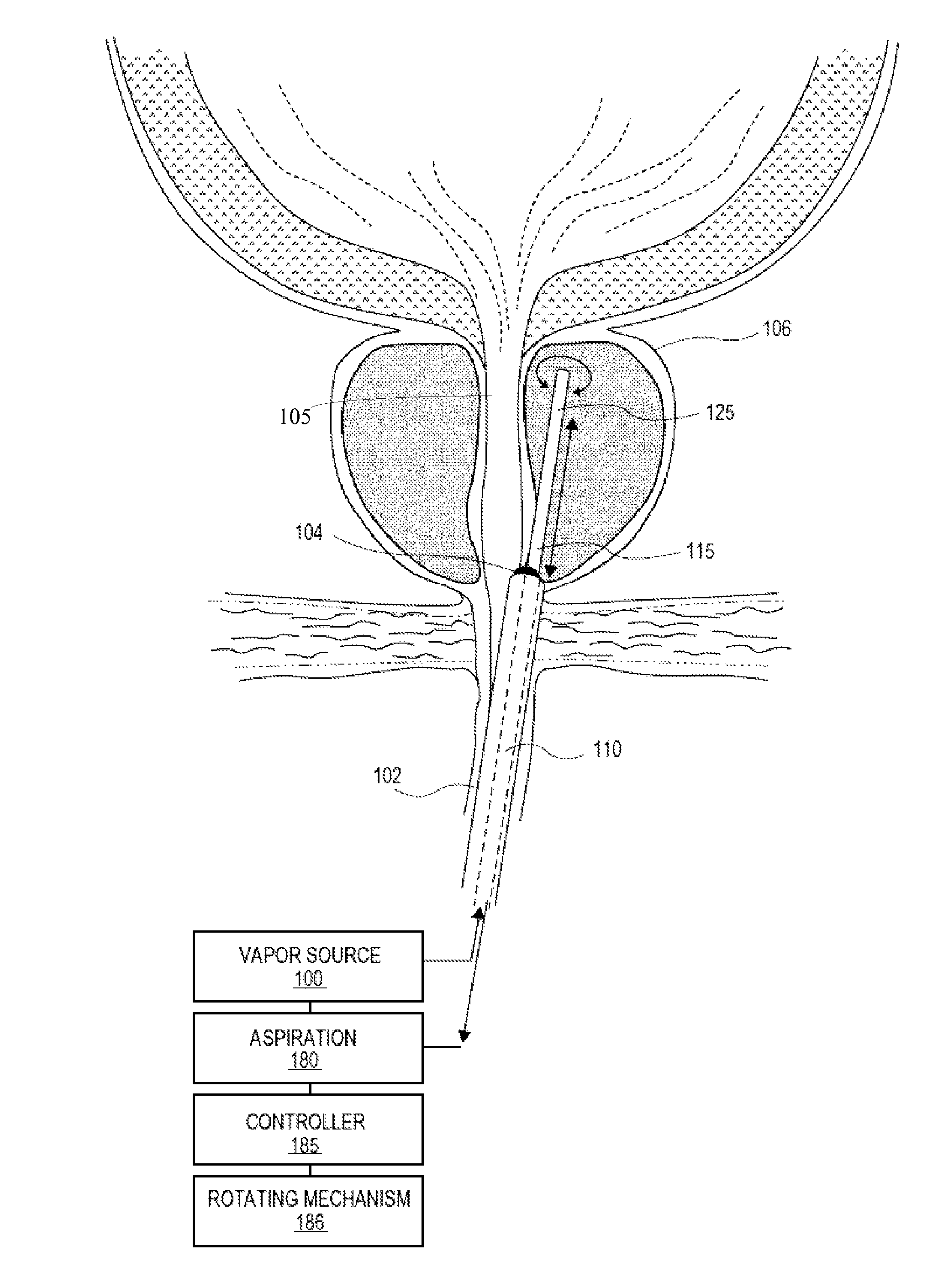 Methods for treatment of prostatic tissue