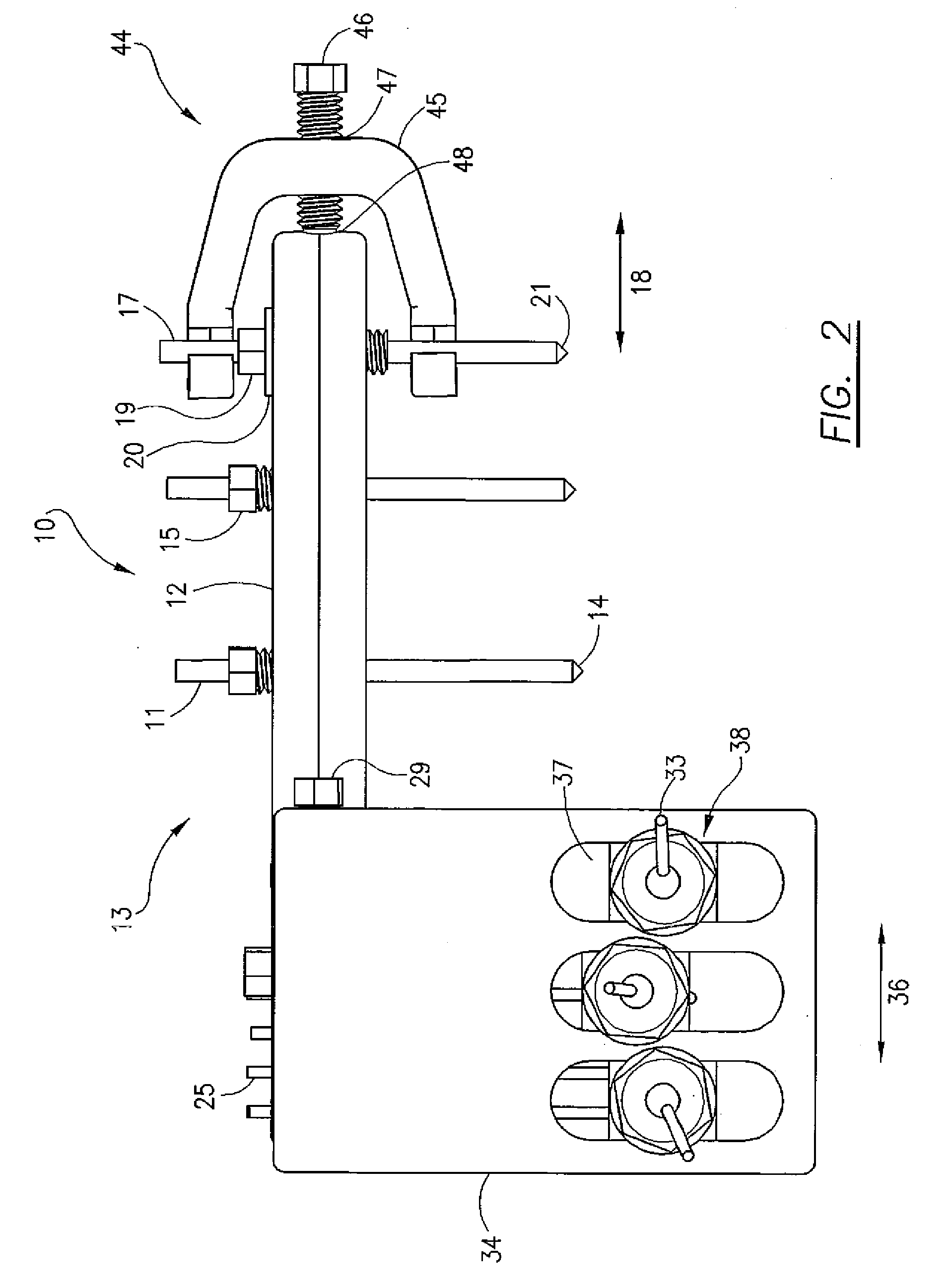 External fixator for distal radius fracture