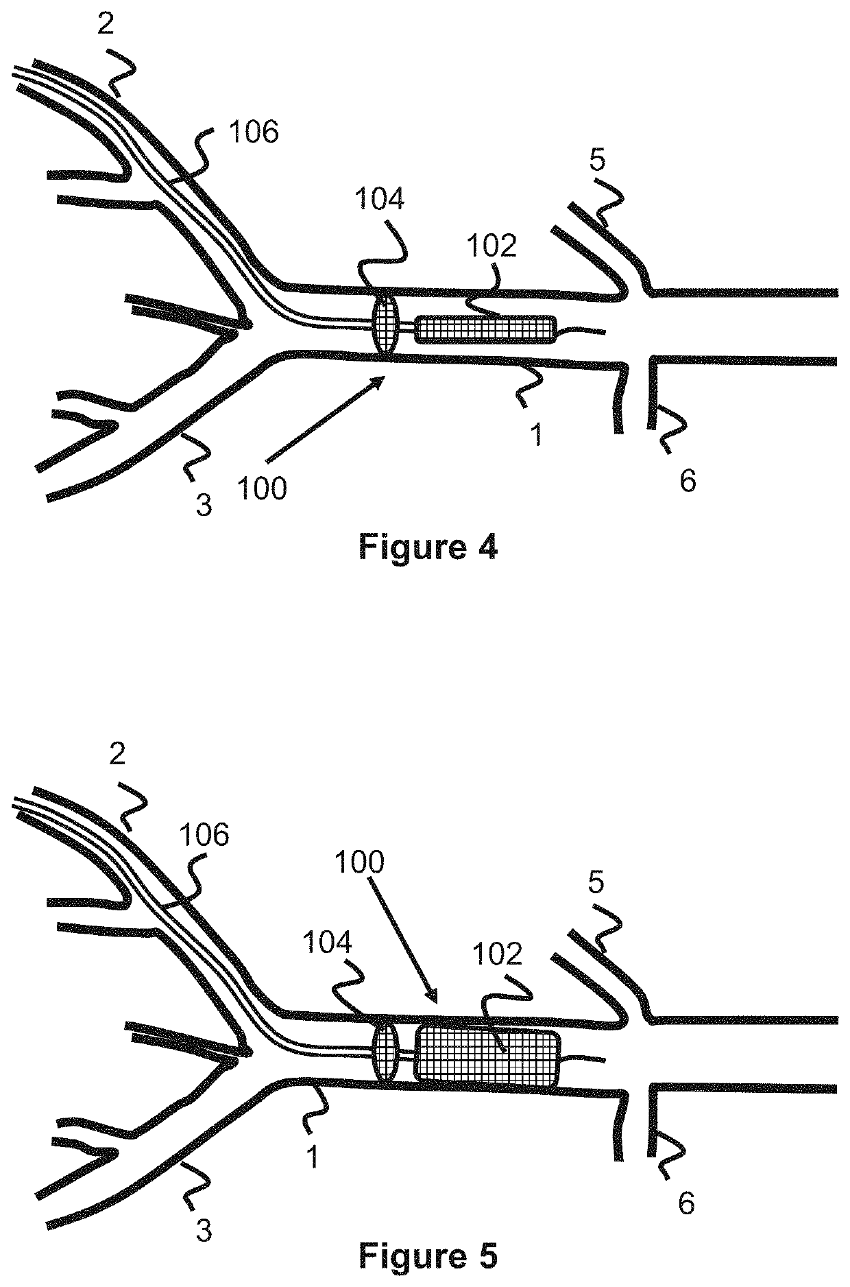 Temporary aortic occlusion device