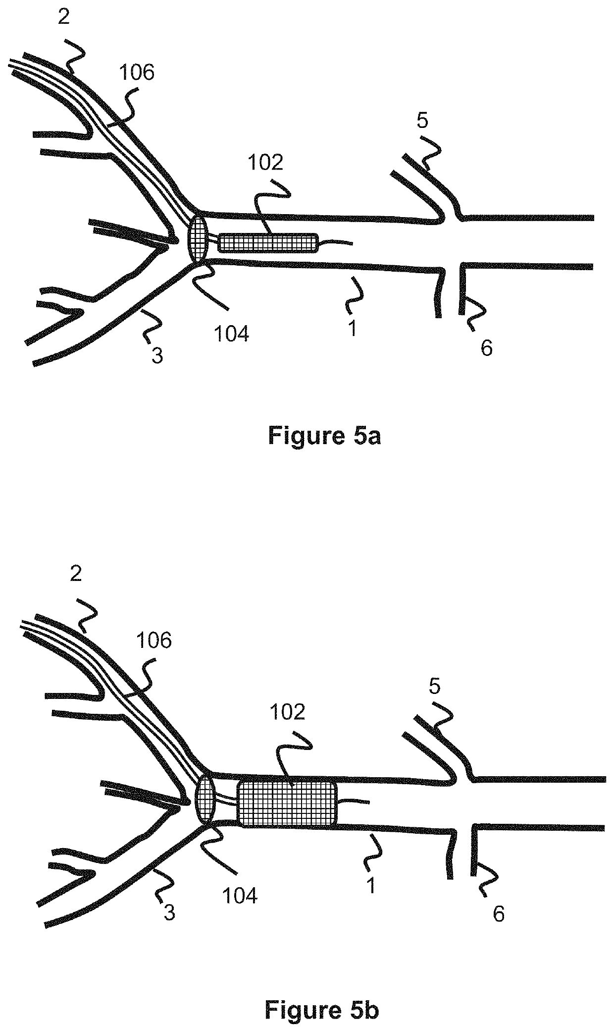 Temporary aortic occlusion device