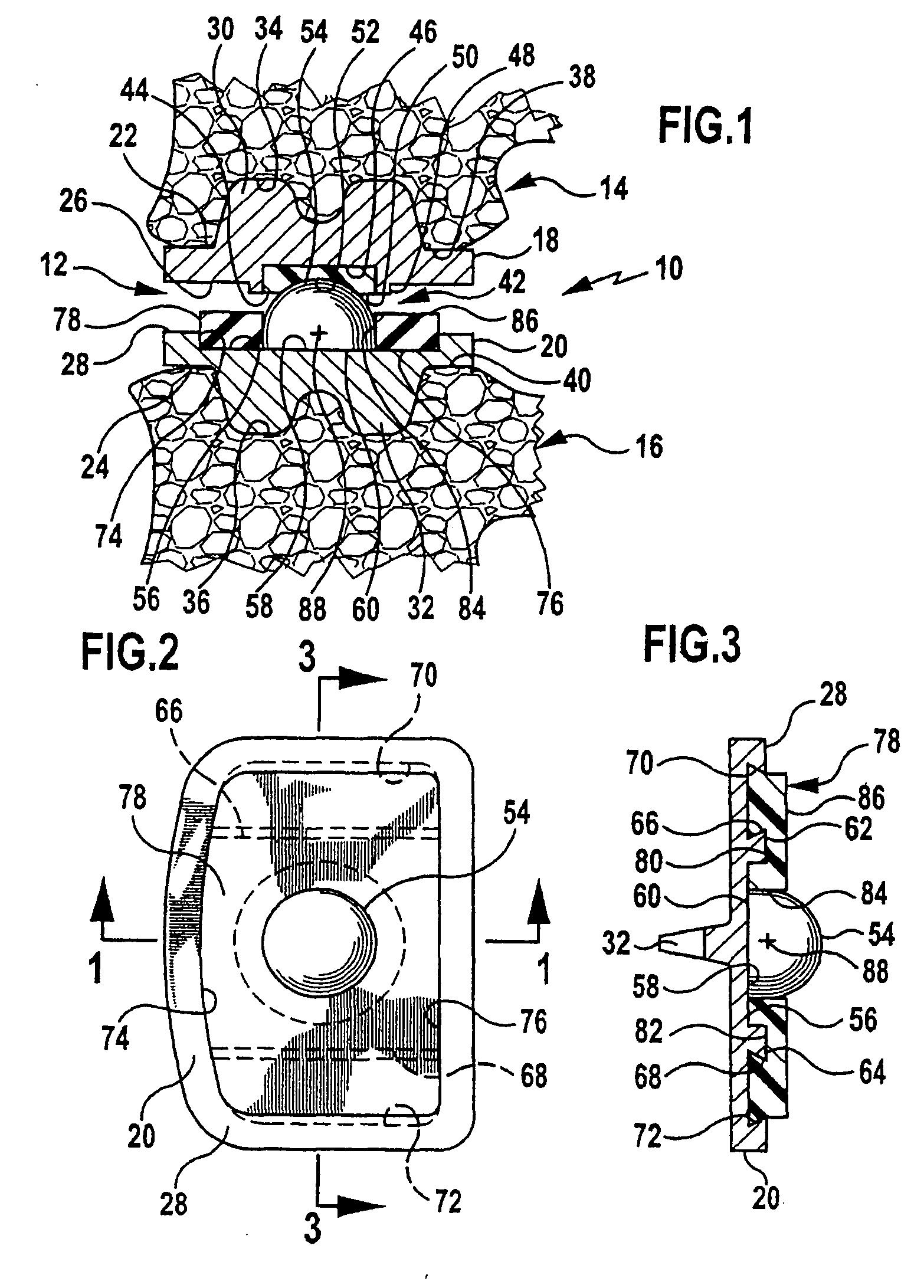 Intervertebral implant