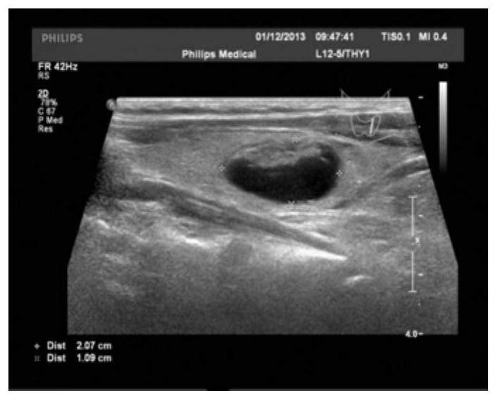 Thyroid nodule real-time segmentation method based on full convolution dense hole network